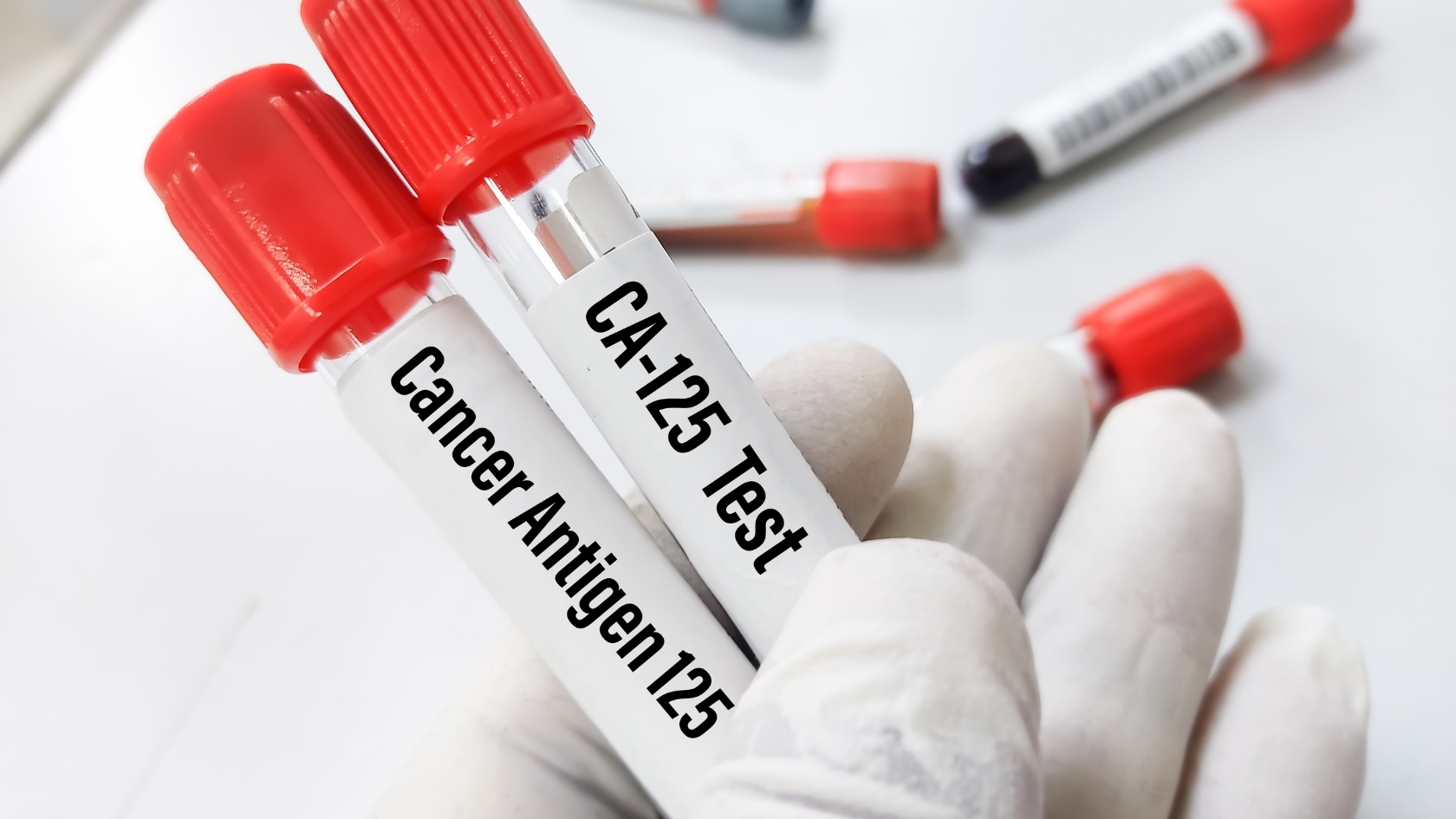 Chỉ số CA 125 là một loại protein được xem là chất chỉ điểm ung thư, thường được sử dụng để hỗ trợ chẩn đoán ung thư buồng trứng