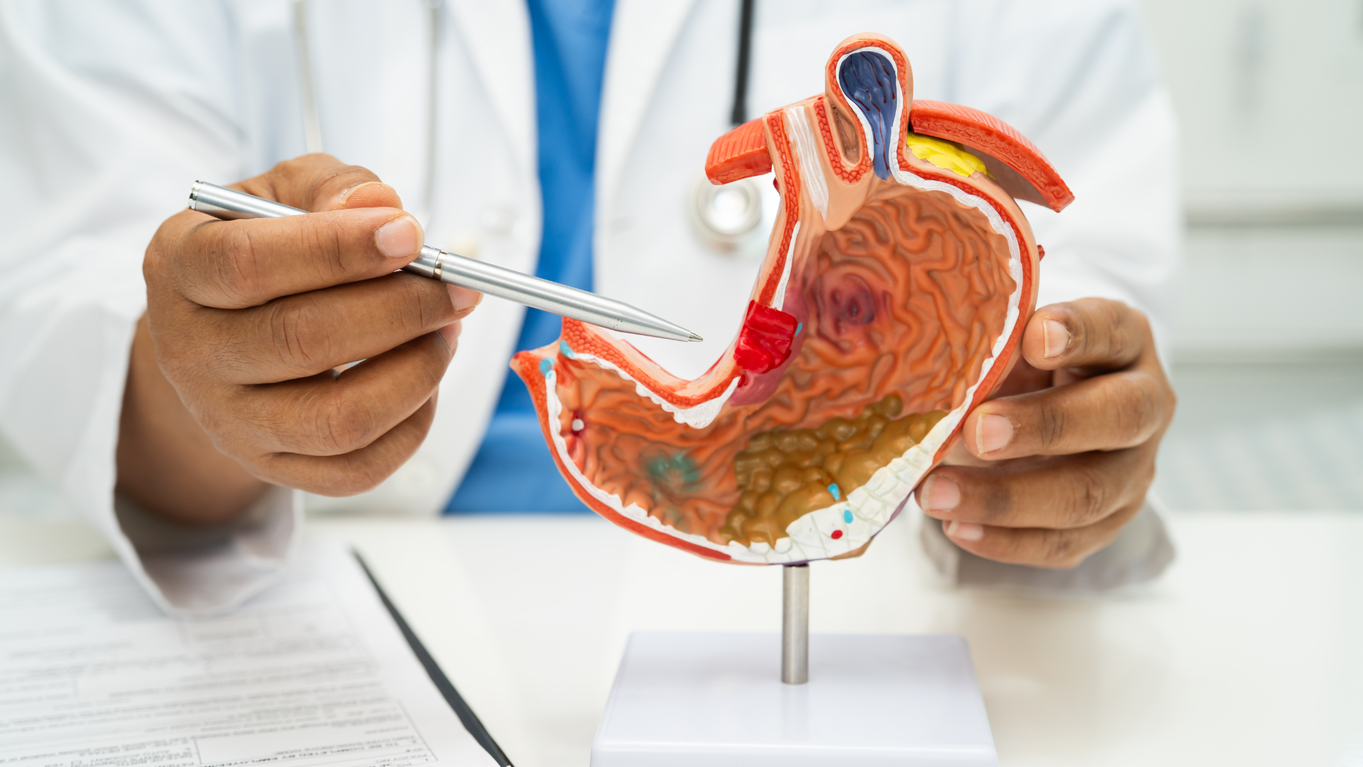 CA 72 - 4 được xem là một trong những dấu ấn tương đối đặc hiệu cho ung thư dạ dày