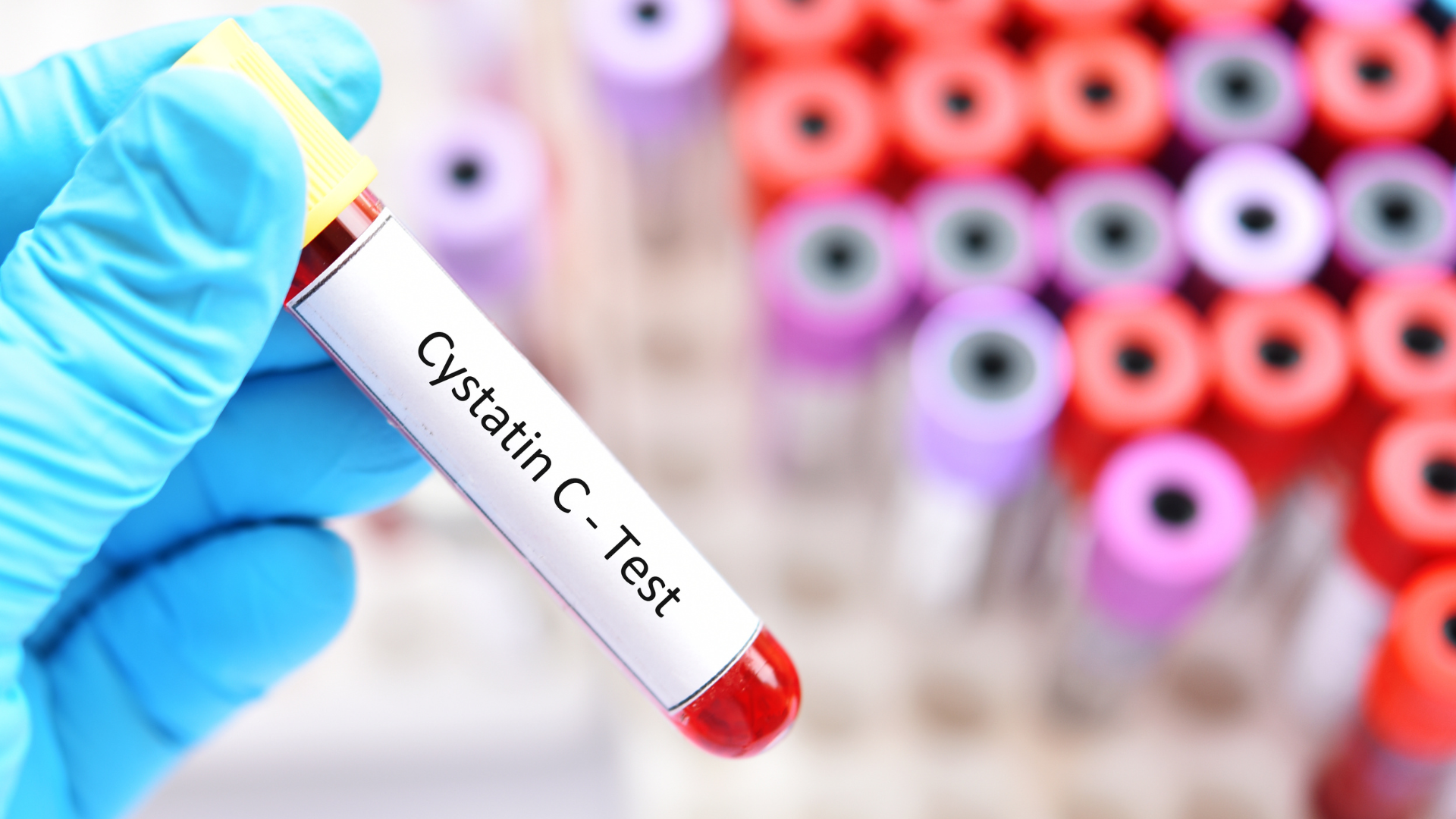 Chỉ số Cystatin C tăng phản ánh thận lọc kém, không nên chủ quan