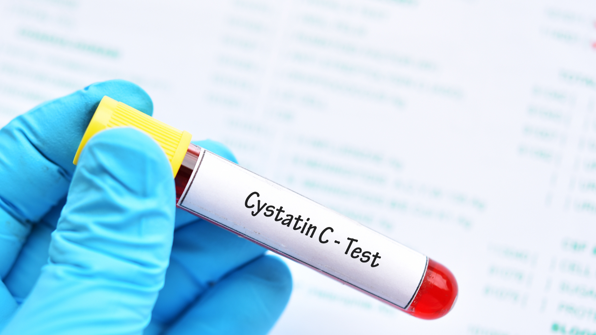 Xét nghiệm Cystatin C đơn giản, chỉ cần lấy máu để kiểm tra