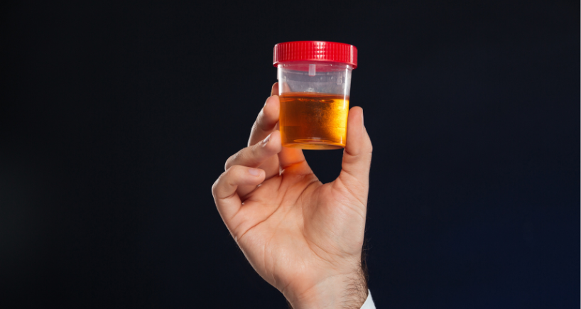 Chỉ số ERY trong nước tiểu 50 thường khiến nhiều người lo lắng về tình trạng sức khỏe tiềm ẩn