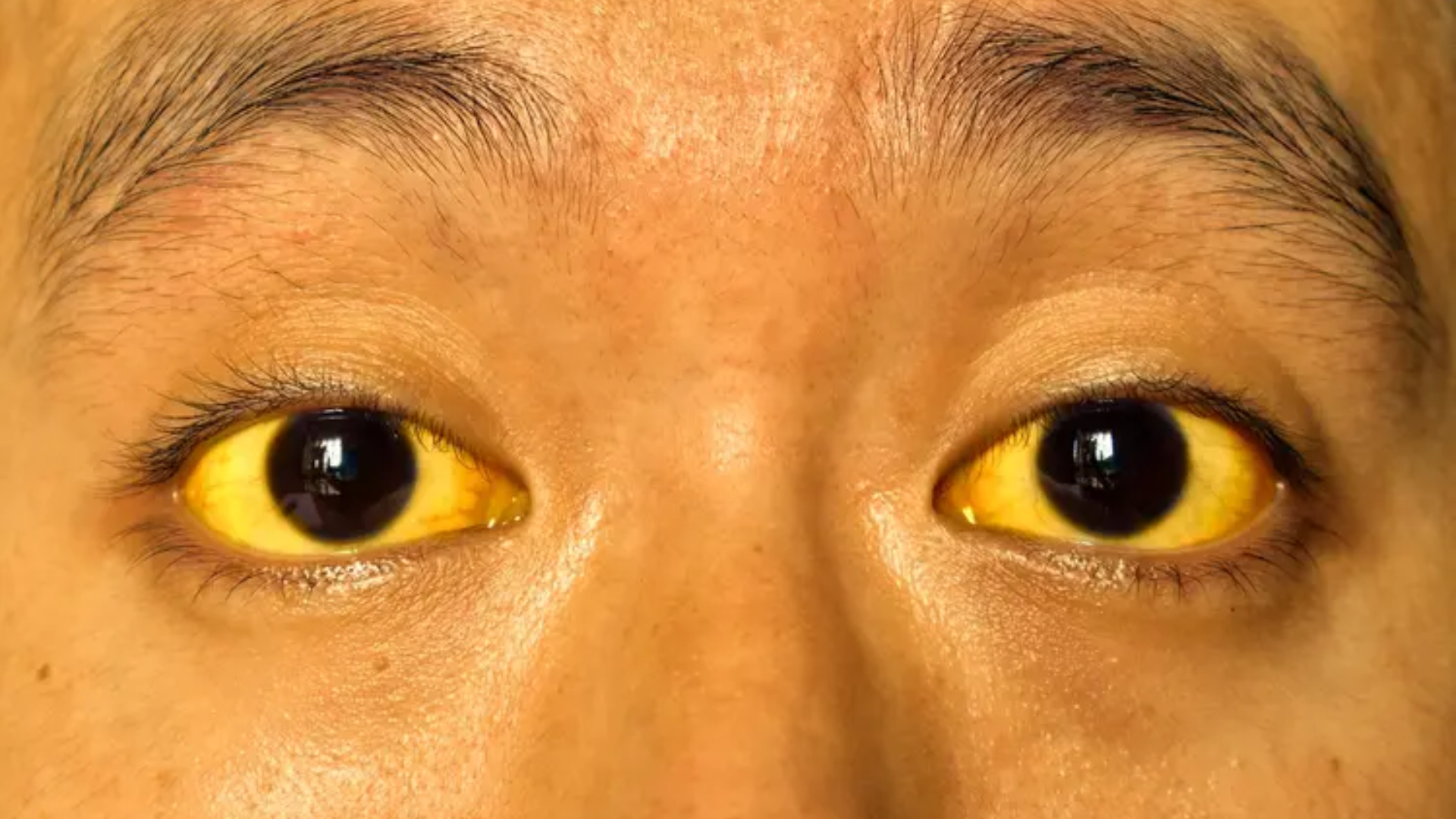 Nếu cơ thể xuất hiện vàng da, vàng mắt, hãy đến bác sĩ để được thăm khám kịp thời