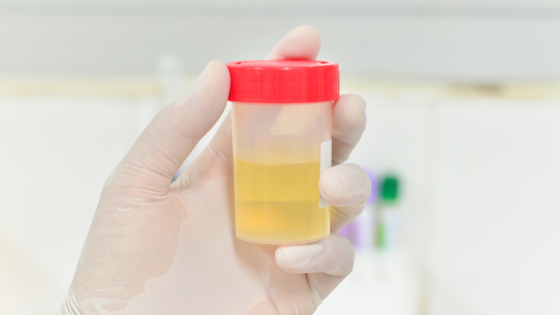 Chỉ số NIT được dùng để phát hiện sự hiện diện của vi khuẩn trong đường tiết niệu