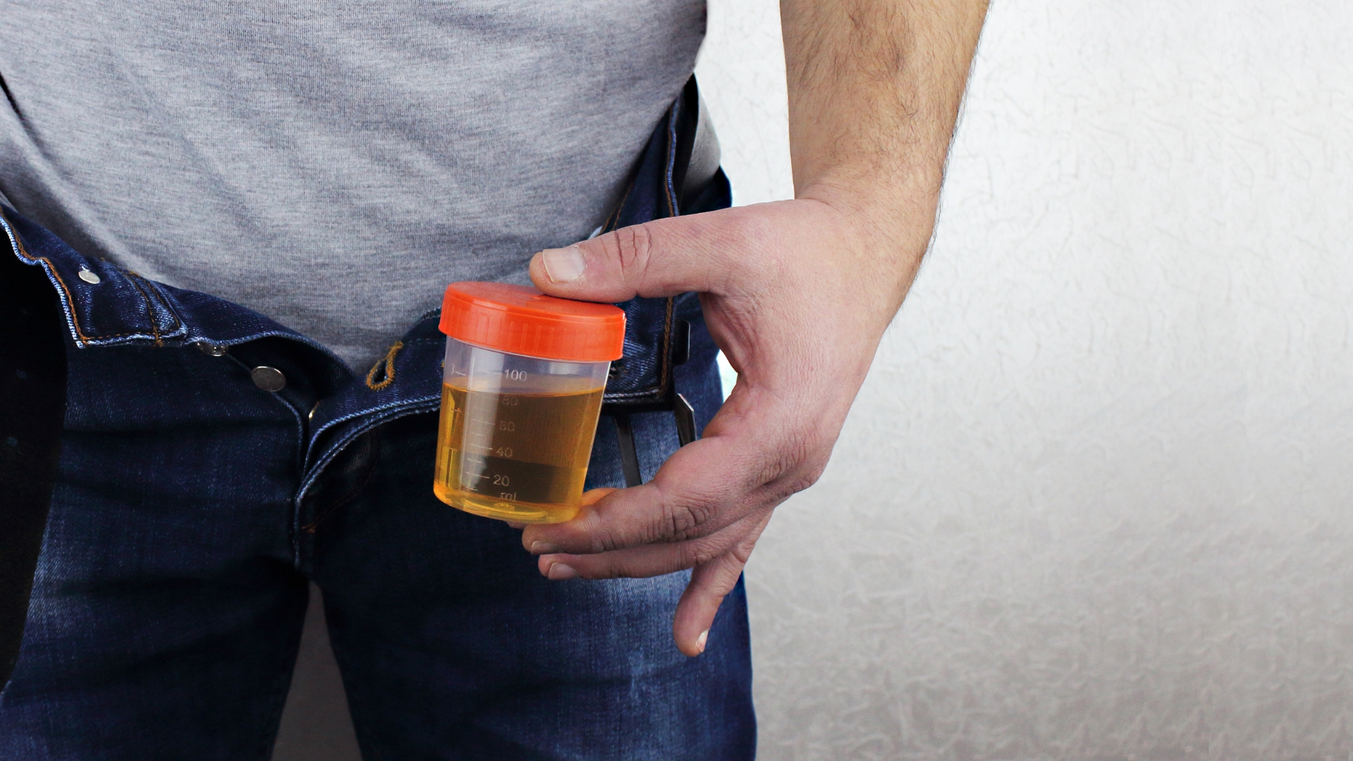 Xét nghiệm chỉ số NIT trong nước tiểu thường được thực hiện khi bác sĩ cần đánh giá nguy cơ nhiễm trùng đường tiết niệu