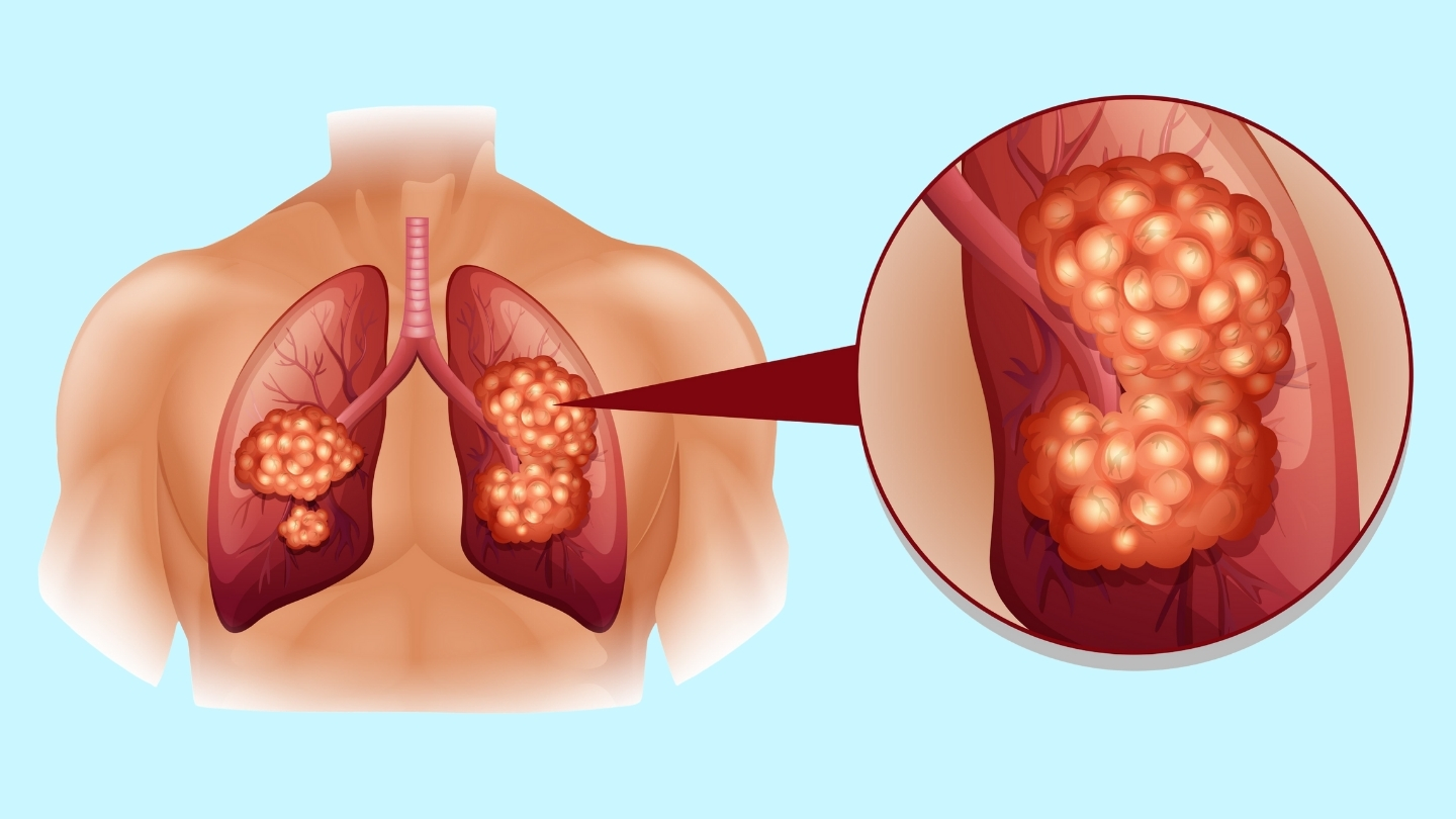 Ung thư phổi không tế bào nhỏ (NSCLC) là nguyên nhân thường gặp nhất làm tăng Cyfra 21-1