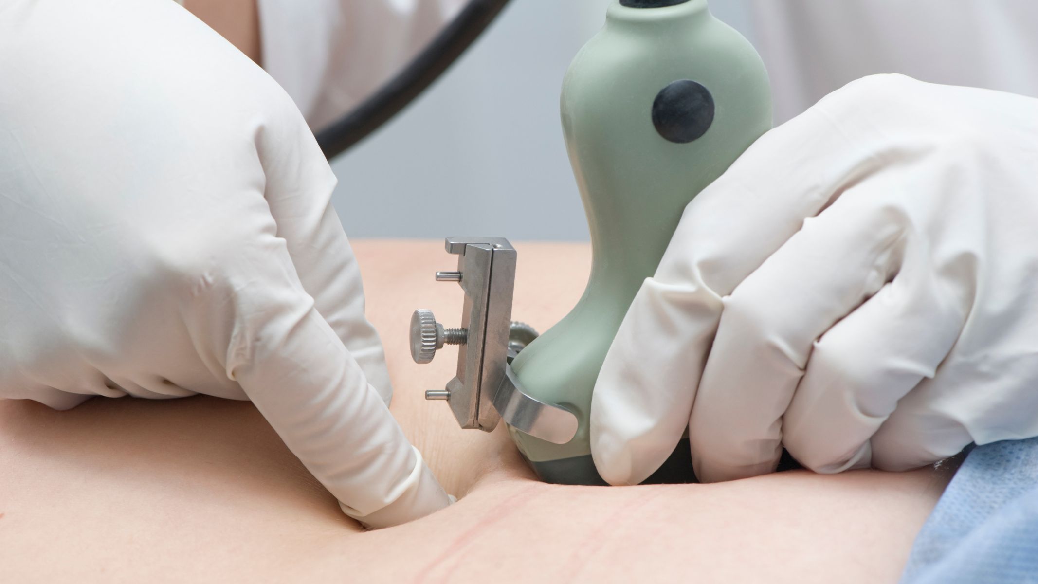 Chọc ối xét nghiệm ADN là phương pháp mà bác sĩ sẽ lấy một lượng nhỏ dịch ối từ túi ối bao quanh thai nhi để phân tích vật liệu di truyền