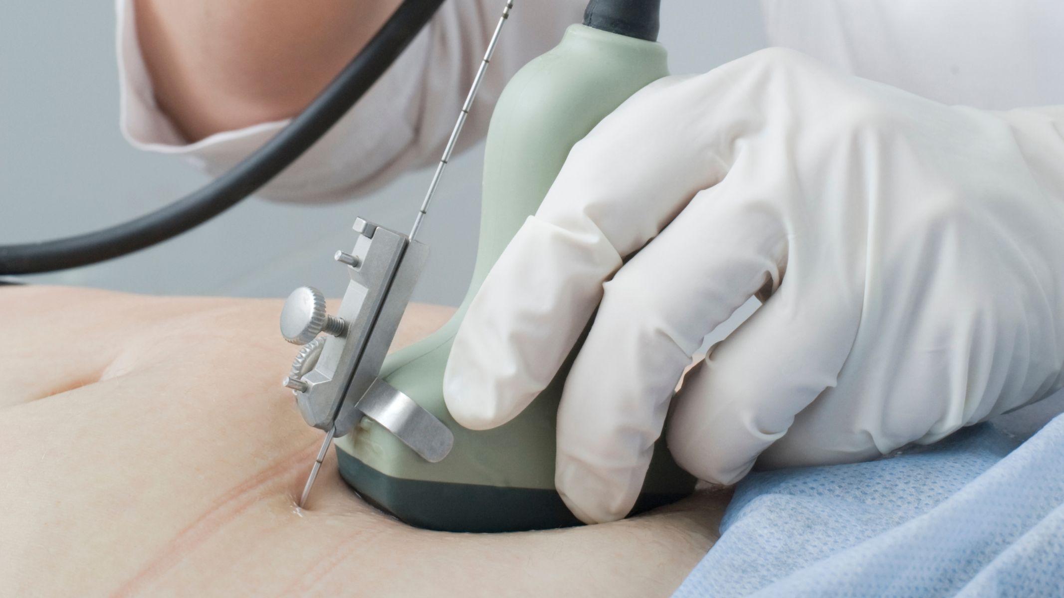 Chọc ối xét nghiệm Down là thủ thuật được thực hiện để phân tích bộ nhiễm sắc thể