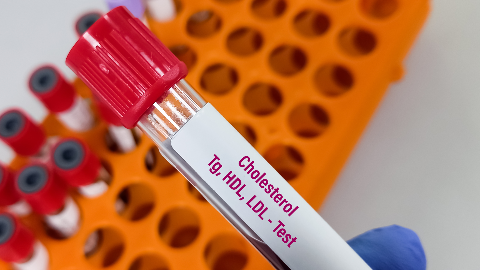 Cholesterol trong máu gồm ba loại chính là LDL, HDL và triglyceride
