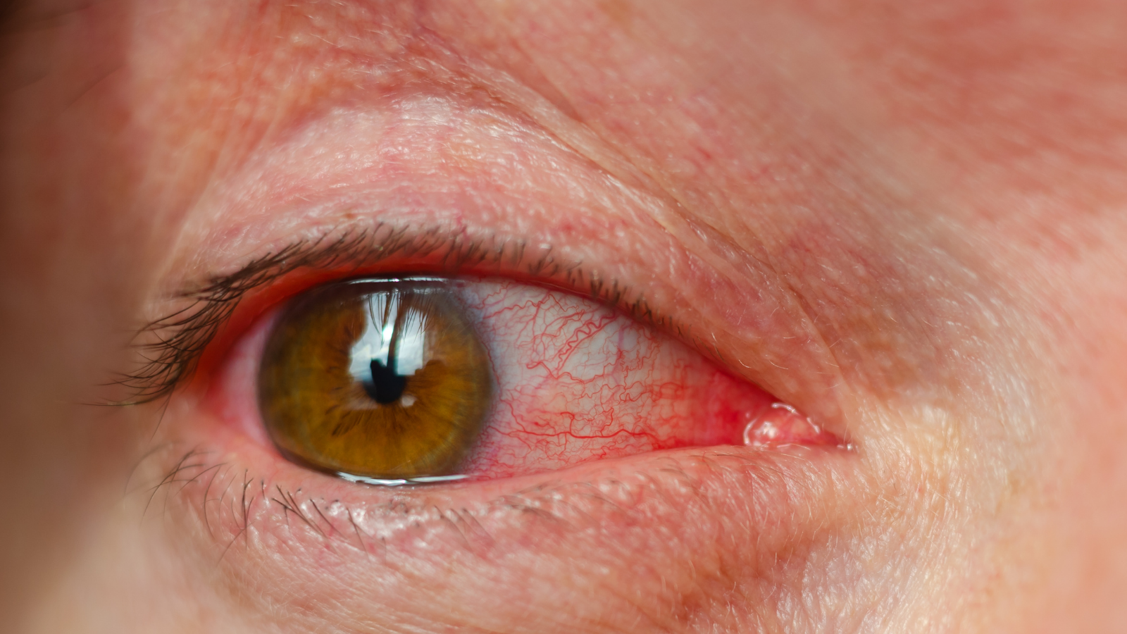 Người bị viêm kết mạc, phẫu thuật mắt gần đây không nên chườm nóng