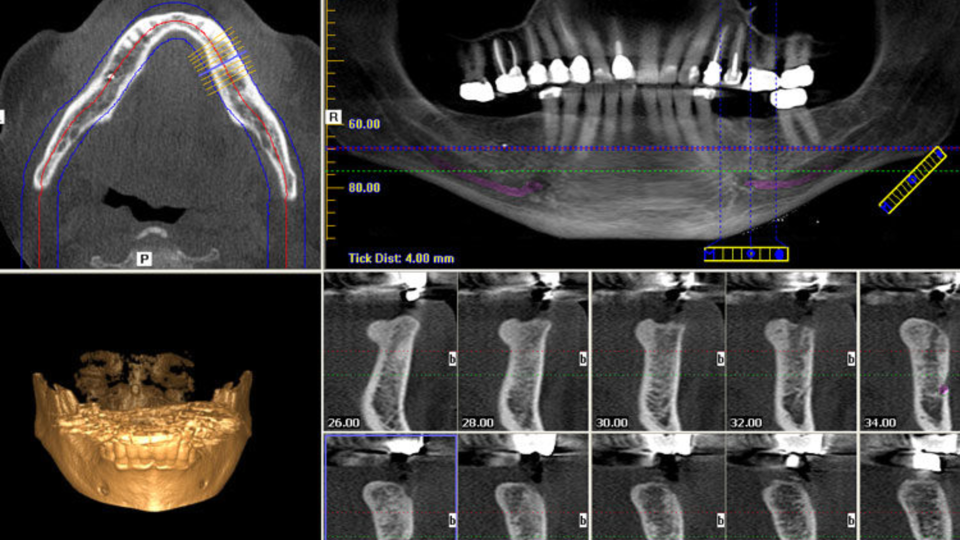 Chụp CT Cone Beam trong nha khoa có ưu điểm nổi bật là cung cấp hình ảnh 3D chi tiết
