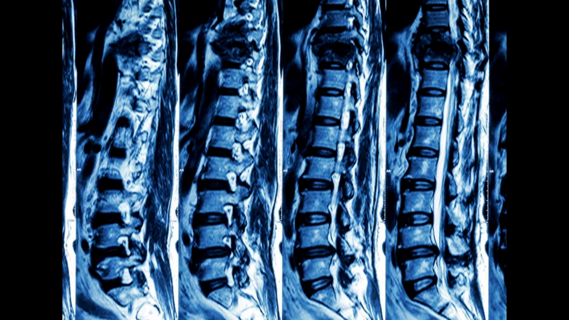 CT cột sống là chụp cắt lớp vi tính vùng cột sống