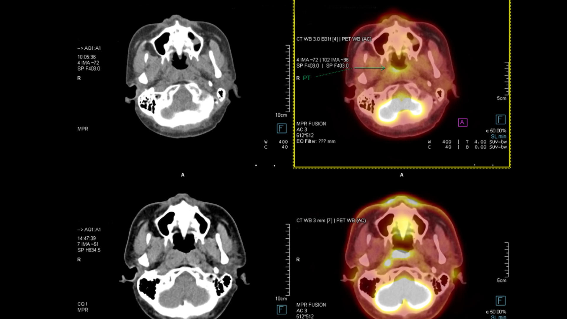 Các yếu tố quyết định chụp CT đầu bao nhiêu tiền thực tế