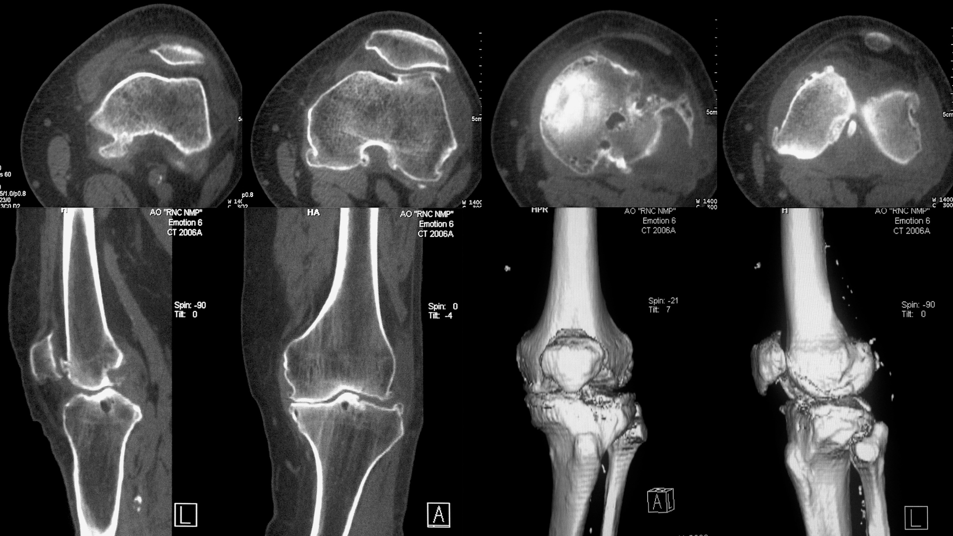 Chụp CT đầu gối (còn gọi là chụp cắt lớp vi tính đầu gối) là một kỹ thuật chẩn đoán hình ảnh hiện đại
