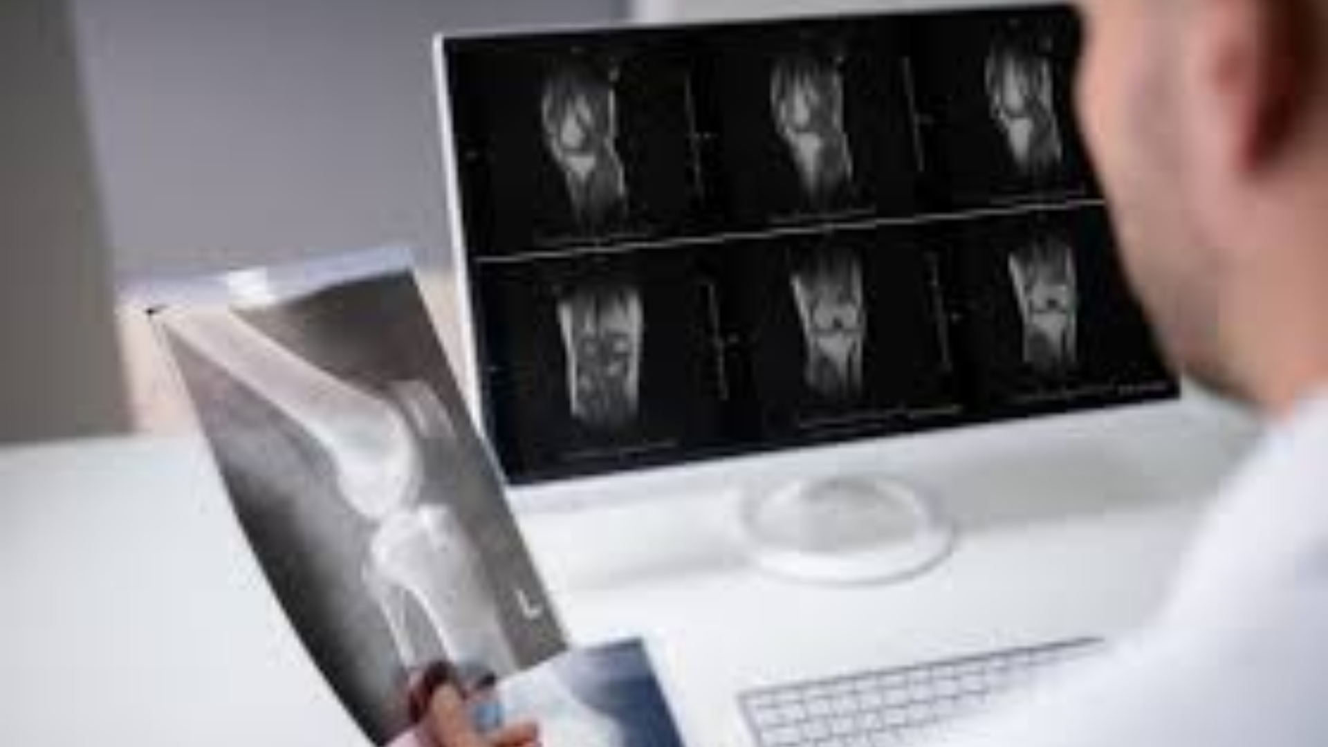 Chụp CT đầu gối giúp bác sĩ quan sát rõ xương, sụn, dây chằng, cơ và mô mềm