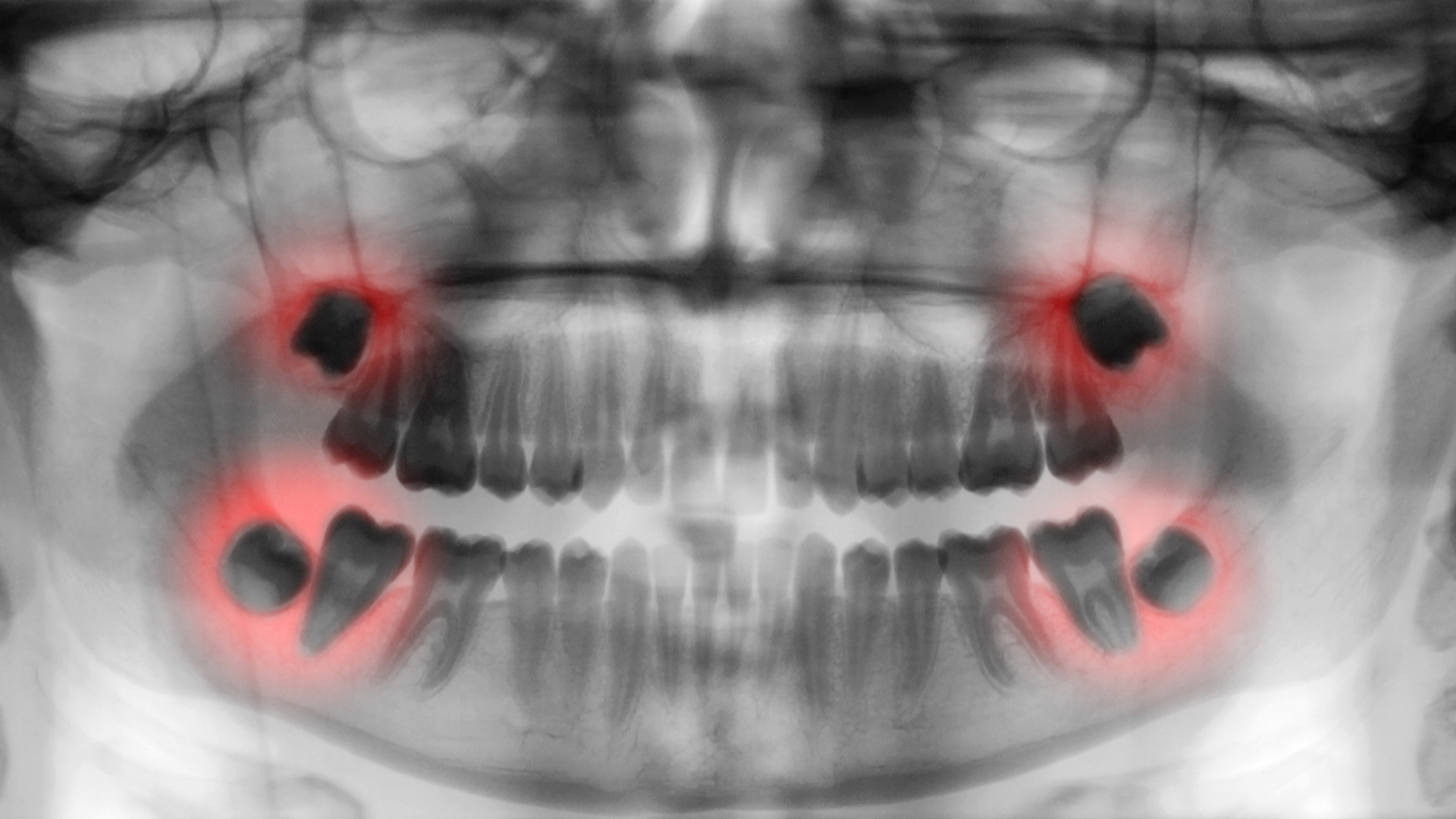 Chụp CT răng có thể phát hiện răng khôn mọc lệch hoặc ngầm