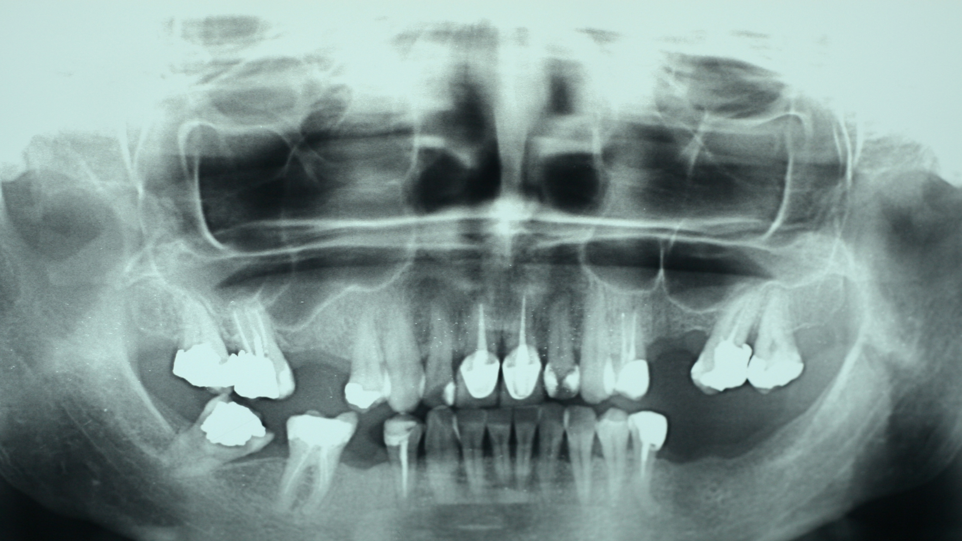 Chụp CT răng là một kỹ thuật chẩn đoán hình ảnh hiện đại trong nha khoa