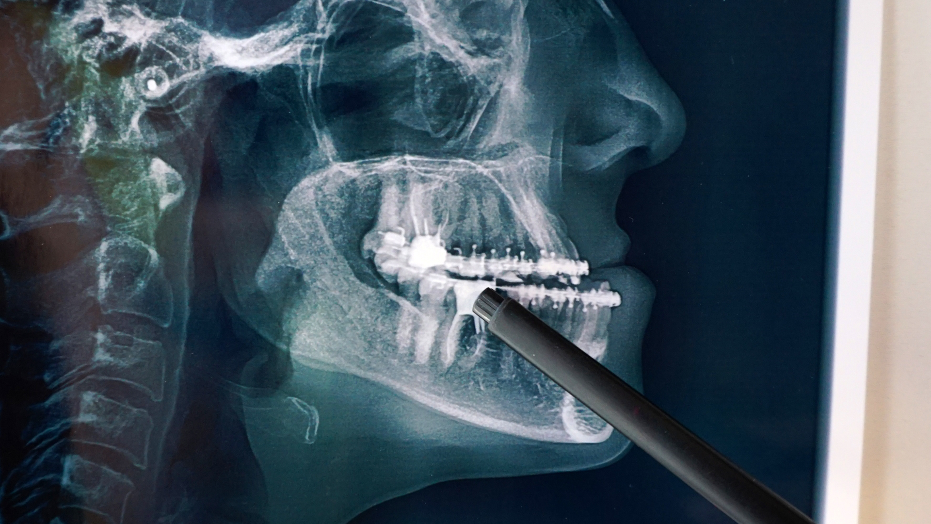 Chụp CT răng không nguy hiểm, vì liều tia X sử dụng trong một lần chụp khá thấp và nằm trong ngưỡng an toàn