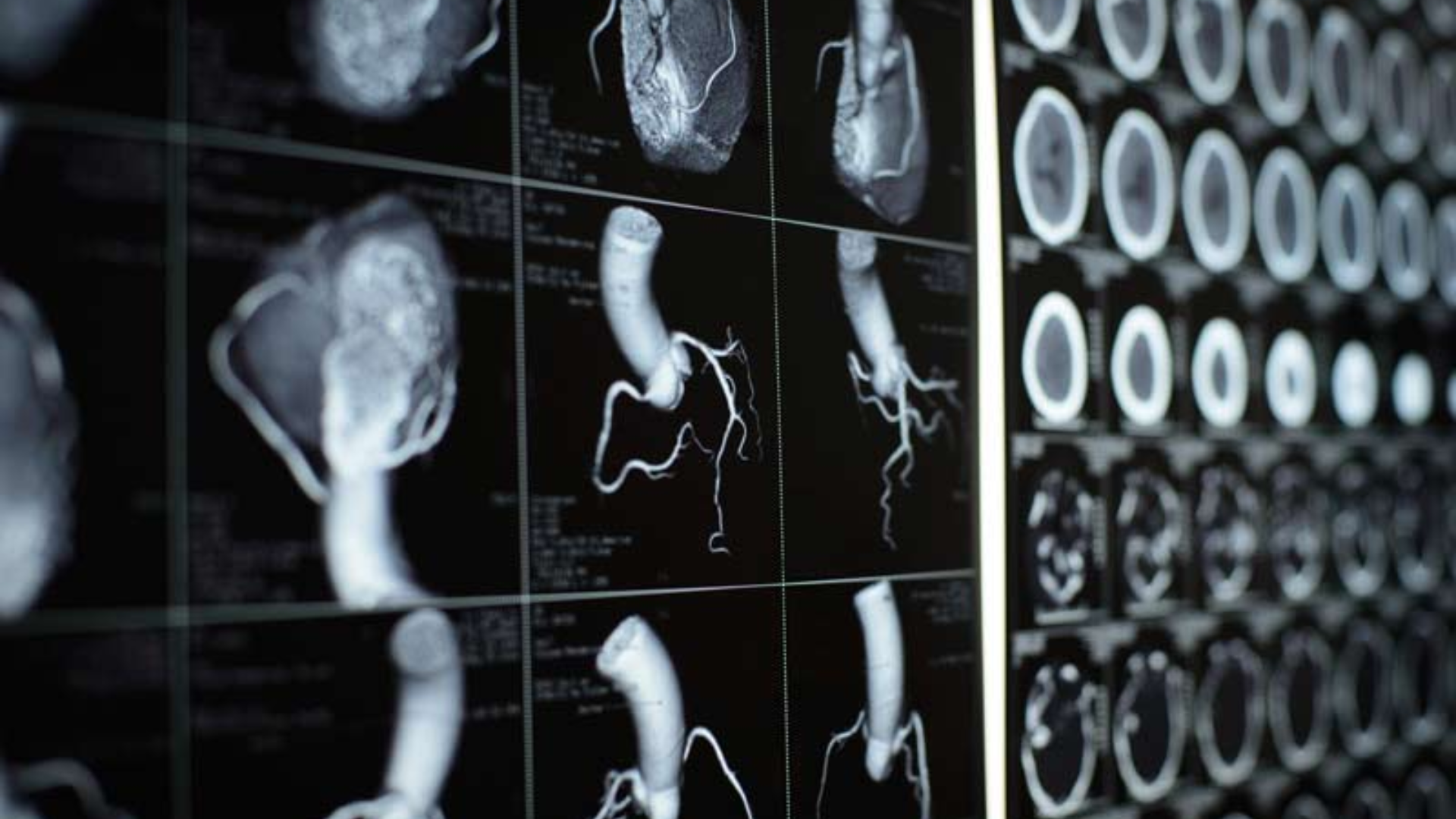 CT tim chuyên biệt cho mạch vành giúp phát hiện hẹp hoặc tắc mạch vành