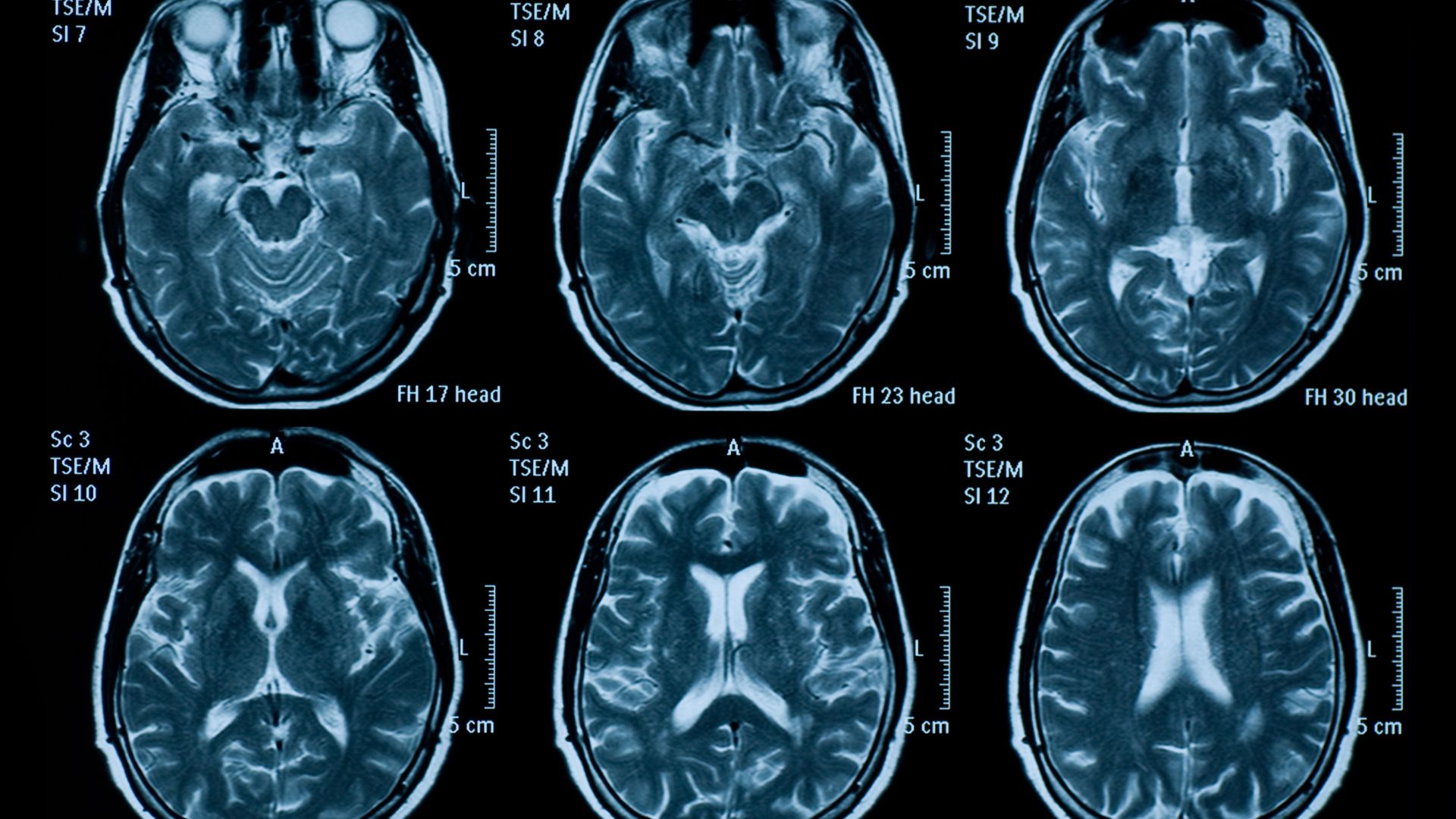 Chụp MRI não bao nhiêu tiền