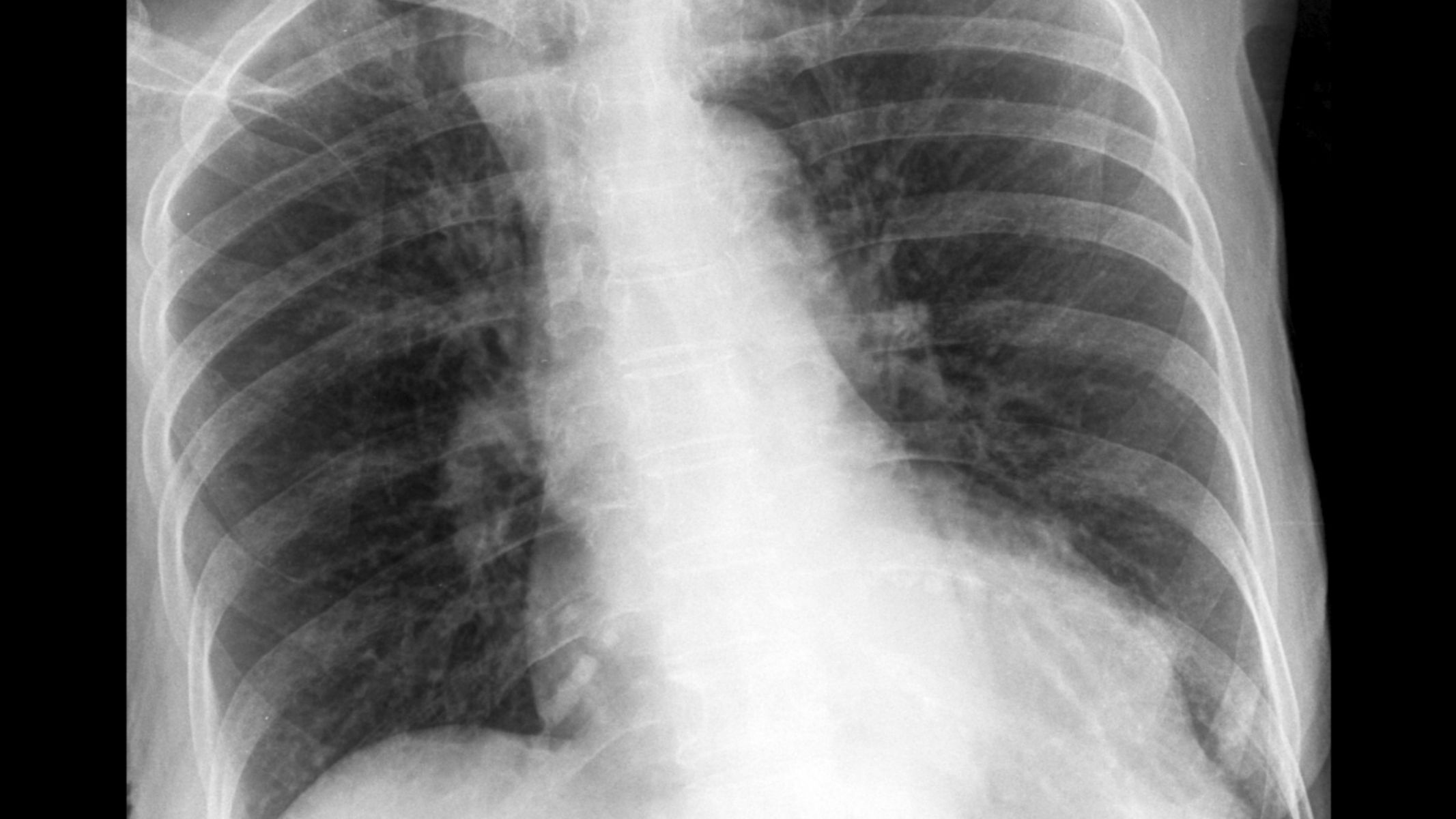 Chụp MRI phổi có khả năng đánh giá các tổn thương phức tạp liên quan đến mô mềm