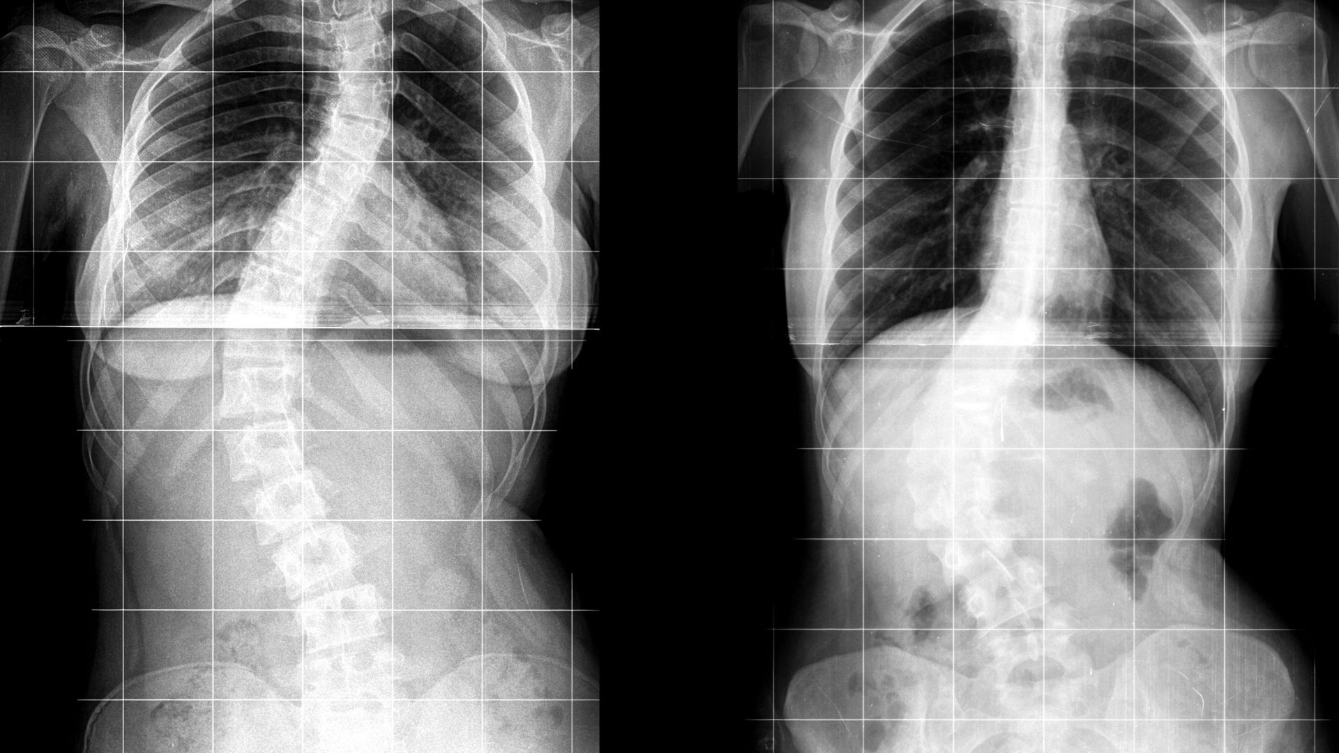 Phương pháp chụp MRI có nhiều giá trị trong chẩn đoán thoát vị đĩa đệm hơn X-quang