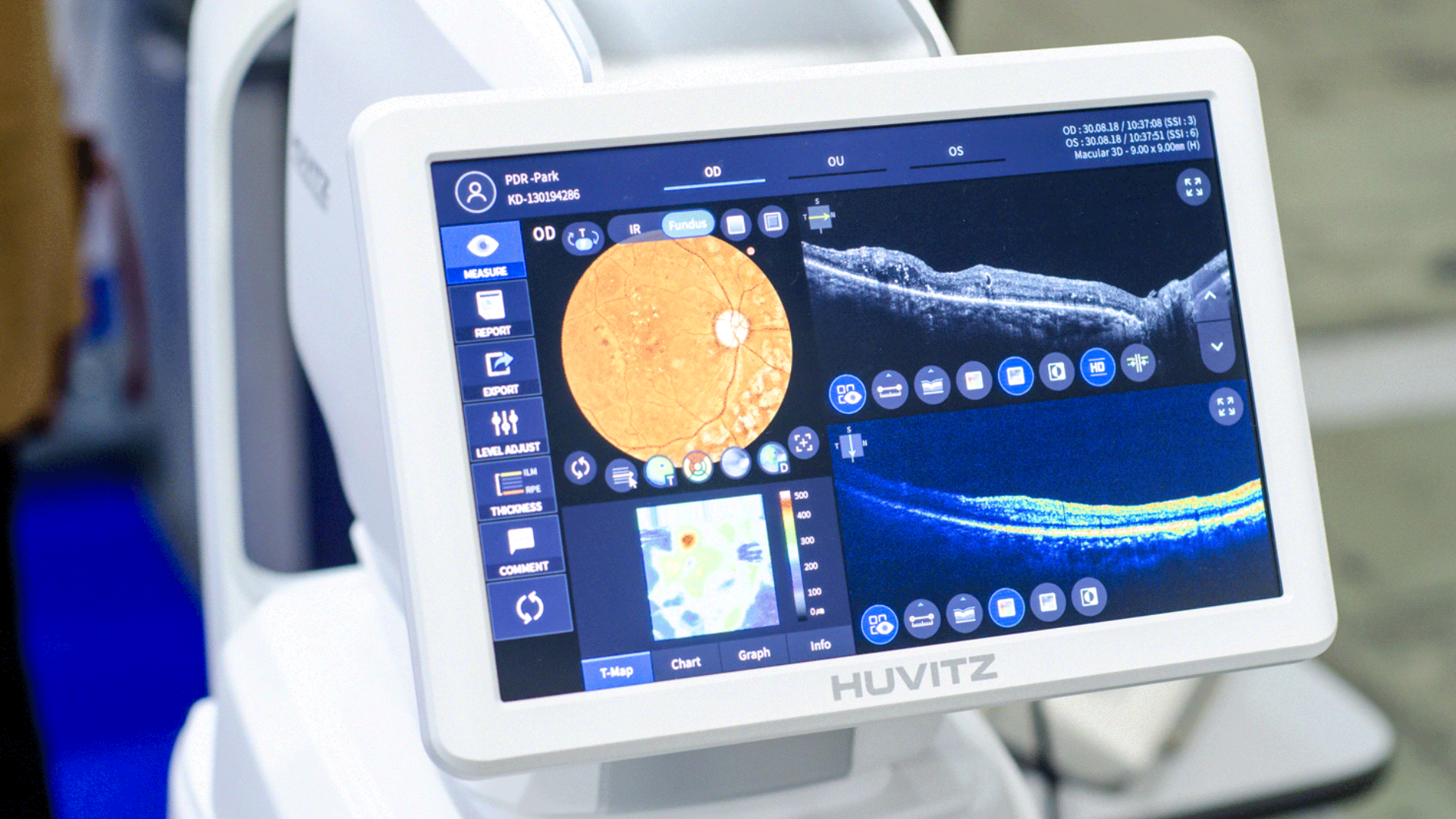 Nên tránh lái xe hoặc làm việc cần thị lực tinh tường ngay sau khi chụp OCT