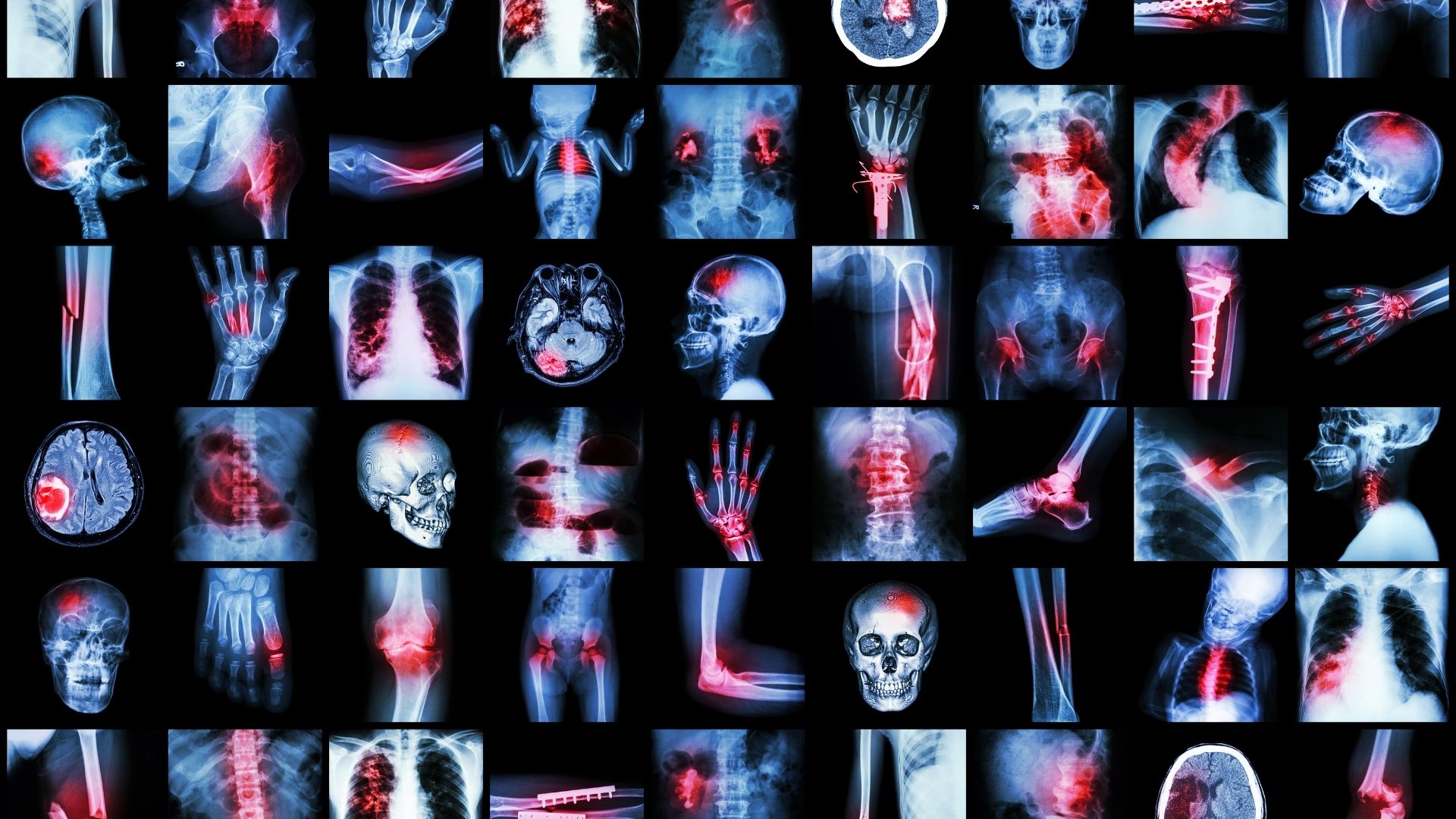 Chụp X-quang giúp phát hiện các bệnh lý về xương khớp