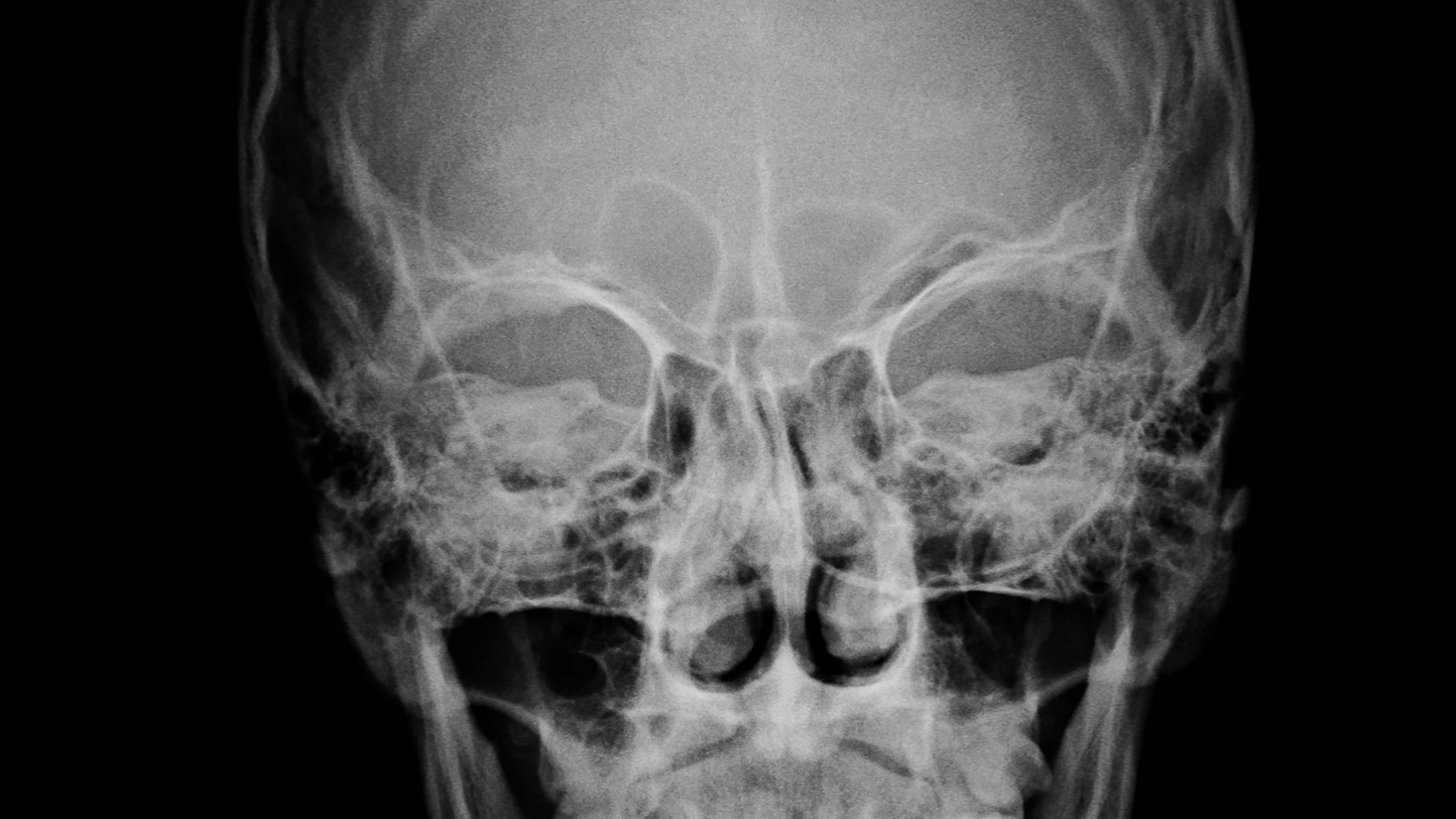 Chụp X-quang đầu sử dụng tia X để ghi lại hình ảnh cấu trúc xương vùng đầu