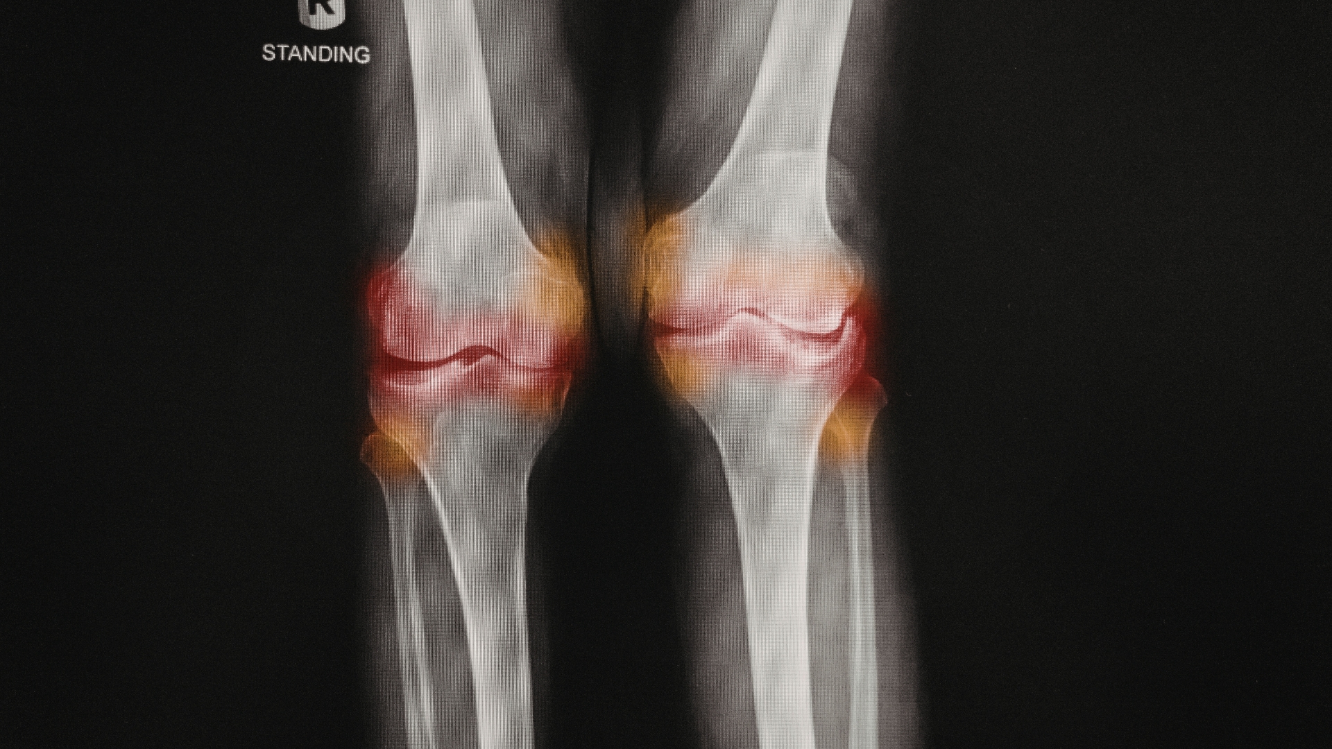 Việc chụp X-quang ở khớp gối ở tư thế đứng được áp dụng khi cần đánh giá tình trạng thoái hóa khớp