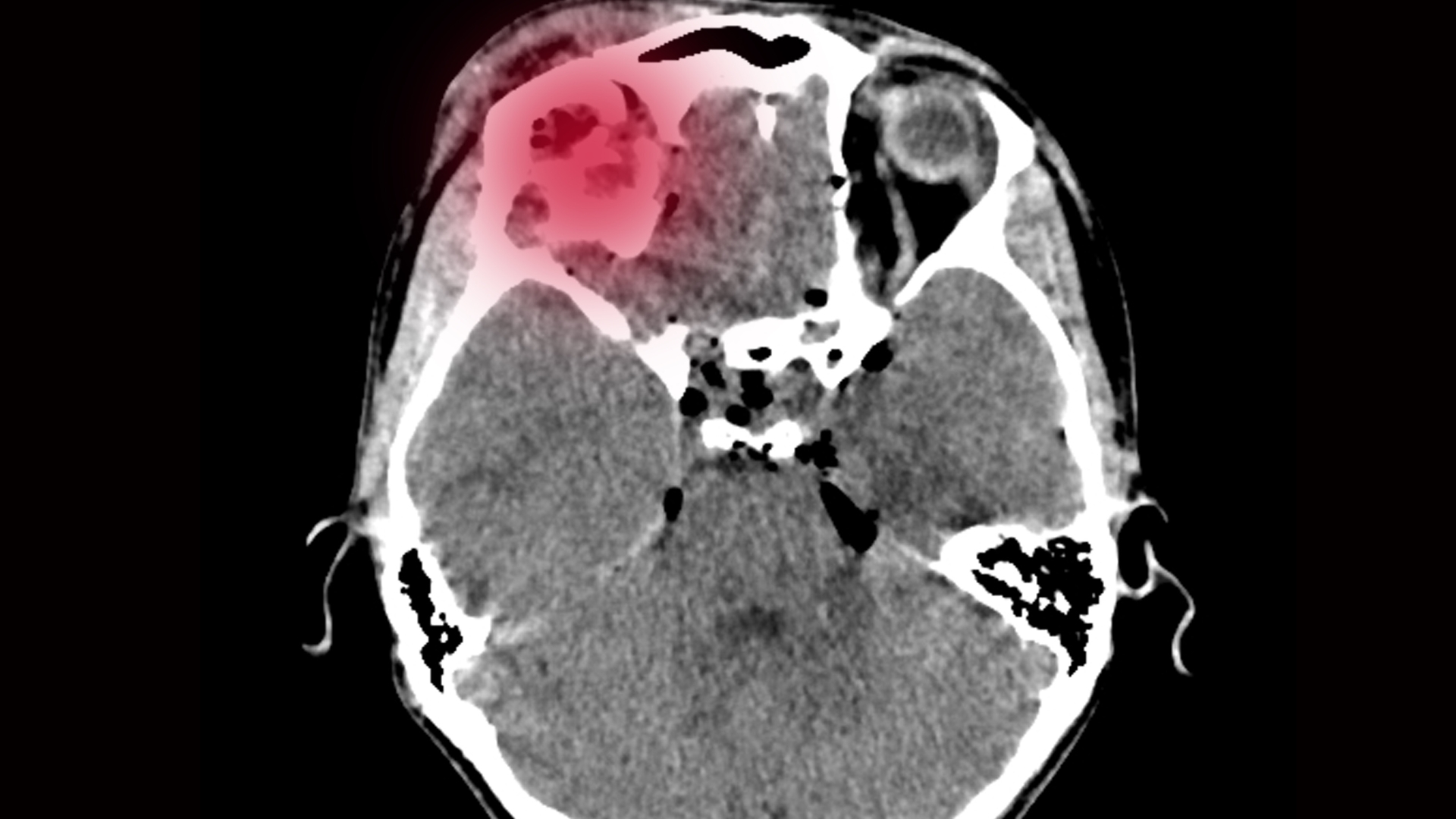 X-quang não không phát hiện được các tình trạng như tụ máu nội sọ