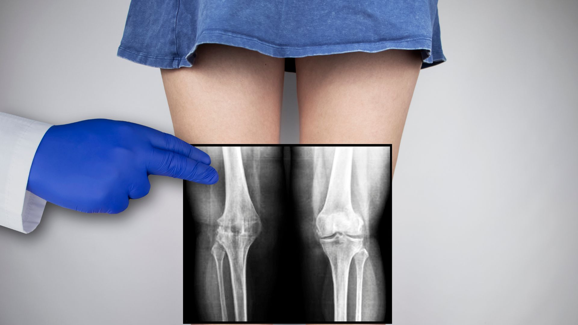 Trước khi chụp X-quang người bệnh cần tháo bỏ các vật dụng kim loại để tránh gây nhiễu hình ảnh