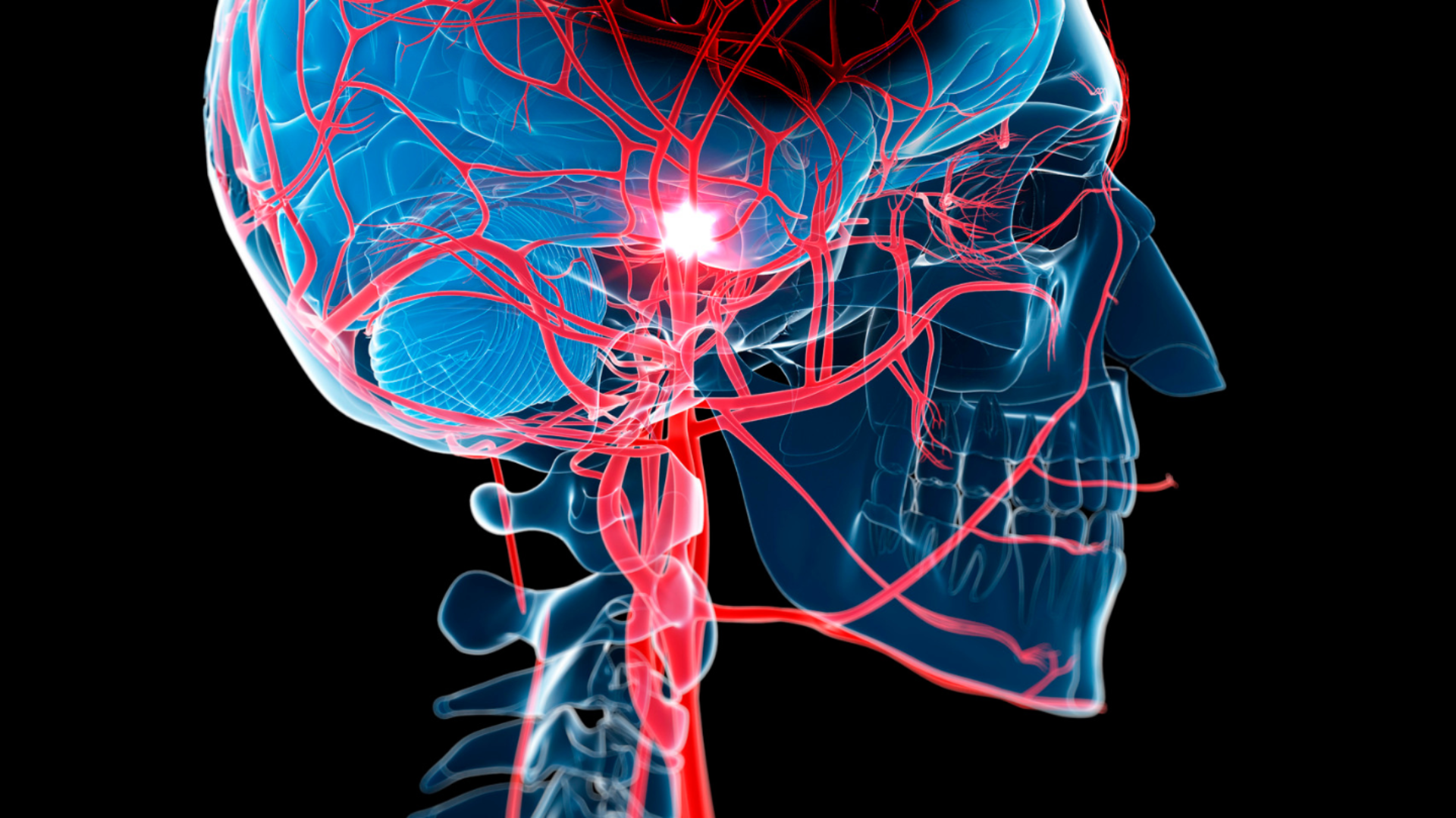 Cơ chế nhồi máu não là quá trình dòng máu lên não bị gián đoạn, gây thiếu oxy mô não