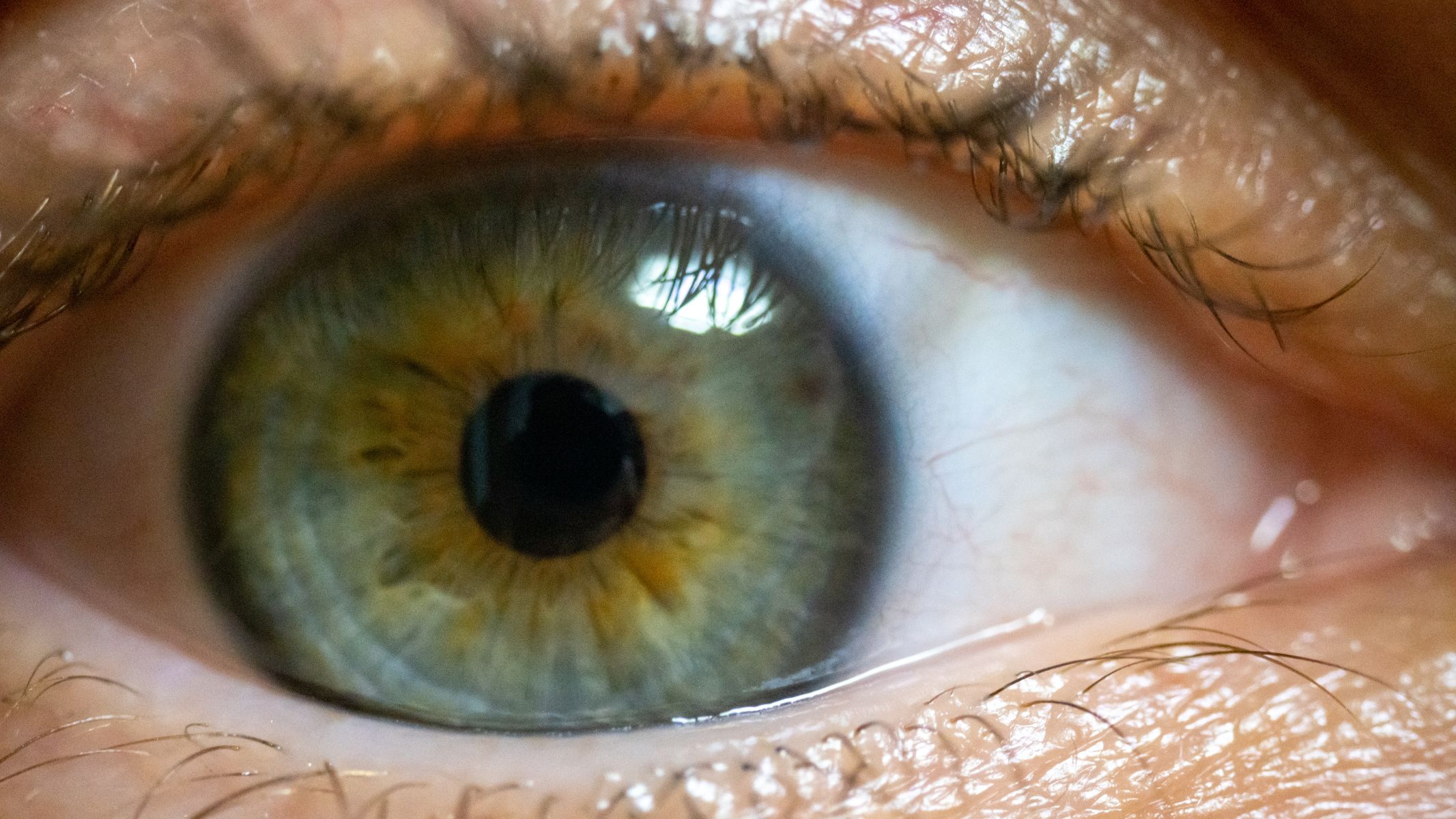 Co đồng tử là tình trạng đồng tử thu nhỏ bất thường