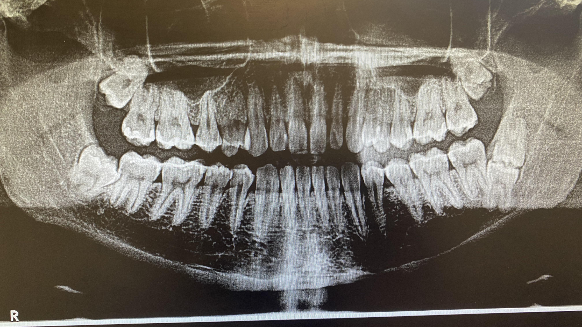 Yếu tố di truyền được ghi nhận là một trong những nguyên nhân gây nên hiện tượng mọc 5 răng khôn