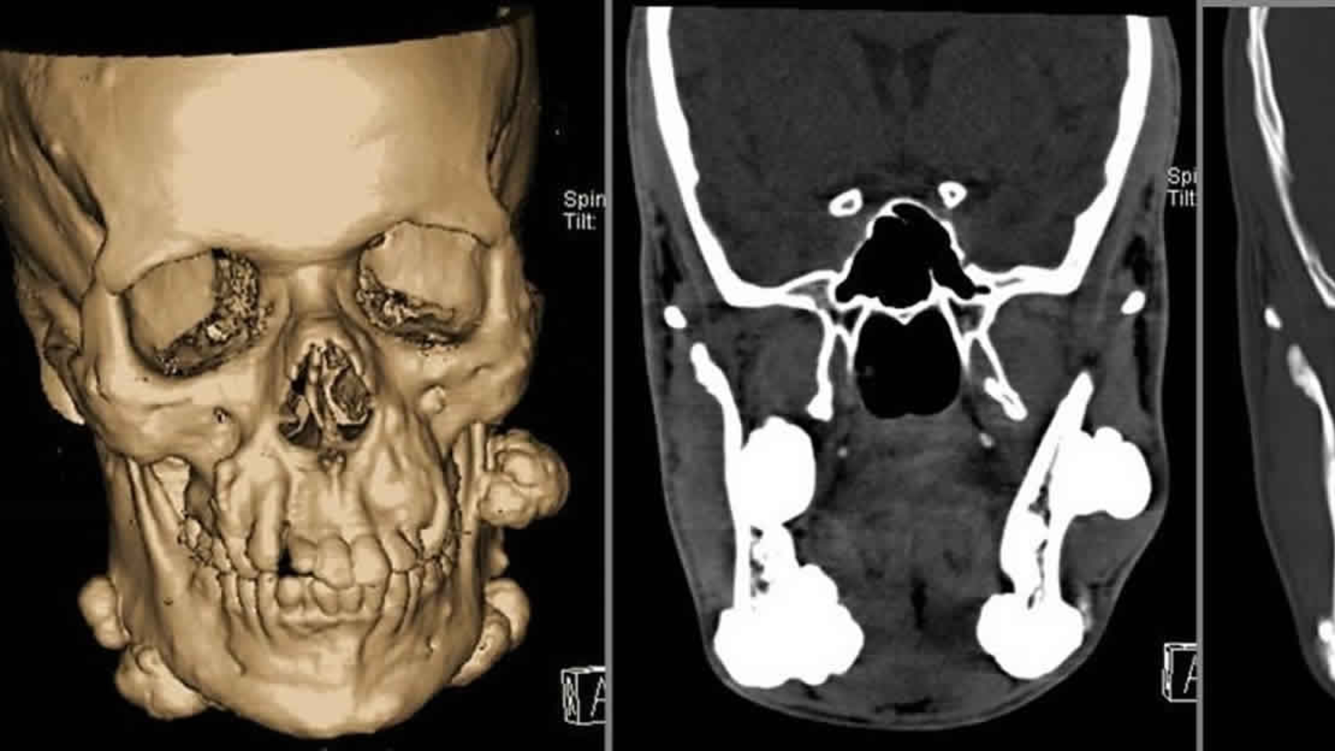 Sự xuất hiện của nhiều răng dư bất thường đôi khi có thể liên quan đến hội chứng di truyền hiếm gặp như hội chứng Gardner
