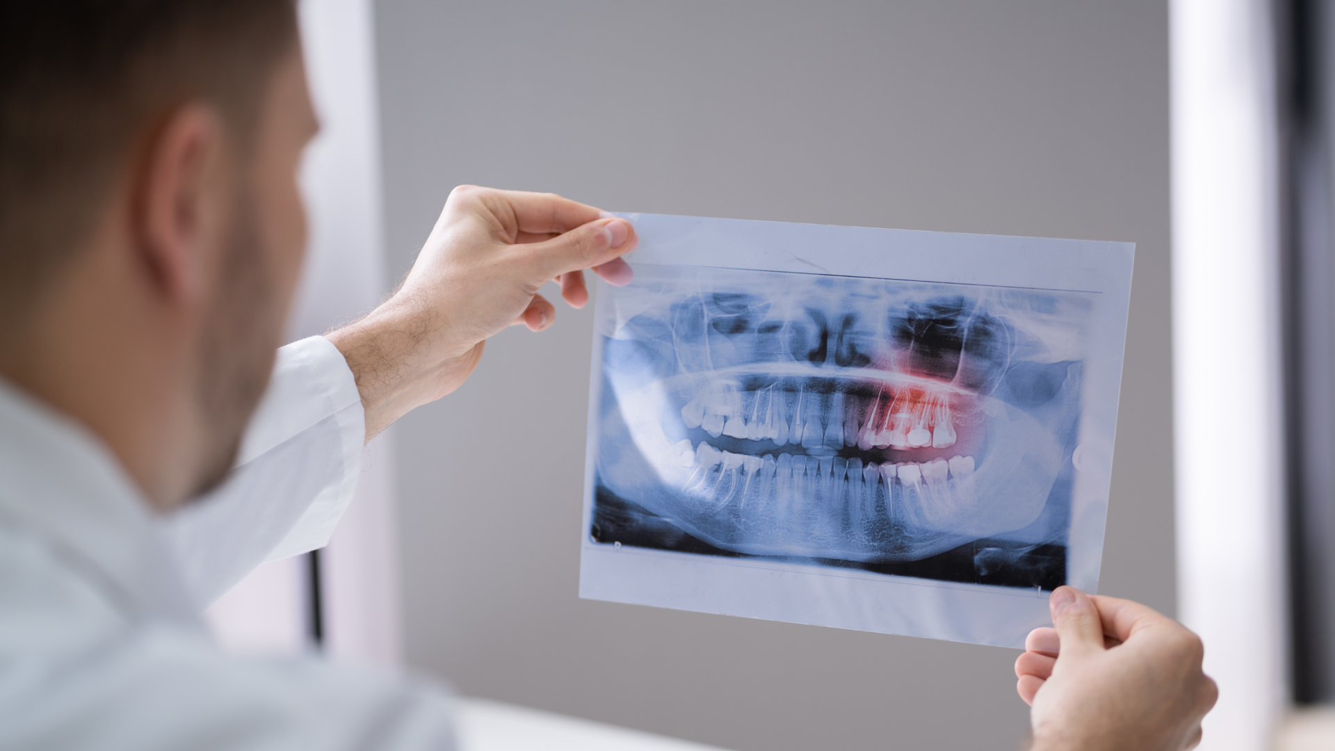 Chụp X-quang toàn hàm hoặc phim cắt lớp nếu cần để xác định chính xác số lượng, vị trí và hướng mọc của tất cả các răng trong xương hàm