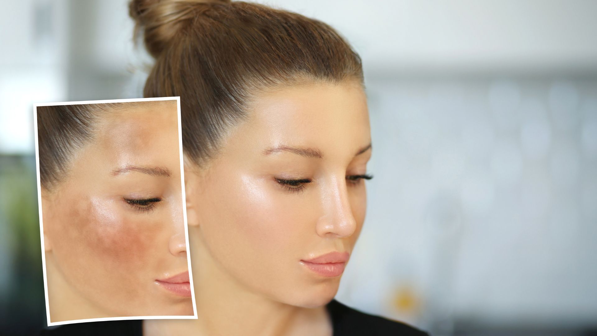 Nghệ có tác dụng hỗ trợ làm mờ thâm, nám và sẹo