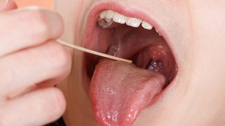 Nếu viêm amidan kéo dài và xuất hiện hốc mủ, việc cắt amidan thường được khuyến nghị