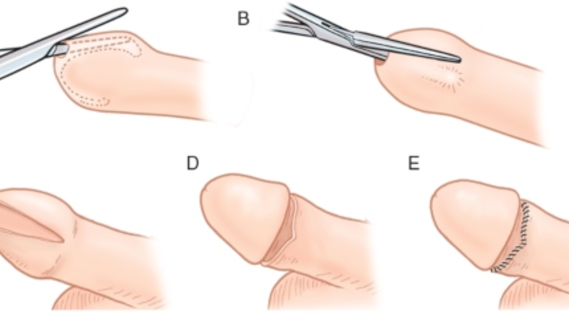 Có nên cắt bao quy đầu không là thắc mắc phổ biến của nhiều nam giới khi quan tâm đến sức khỏe sinh lý và vệ sinh cá nhân