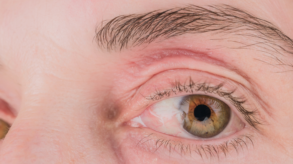 Khi mộng phát triển lớn có thể kéo căng giác mạc khiến tầm nhìn bị mờ đục