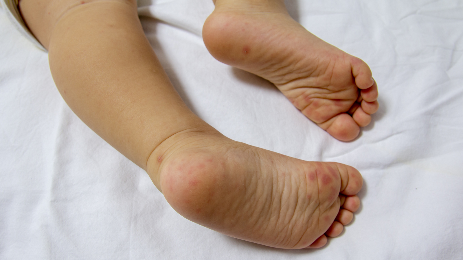 Tay chân miệng là bệnh truyền nhiễm do virus Enterovirus gây ra ở trẻ nhỏ