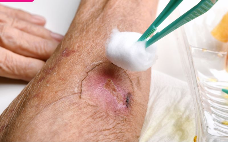 Việc nặn mủ không đảm bảo vệ sinh có thể gây nhiễm trùng nặng hơn