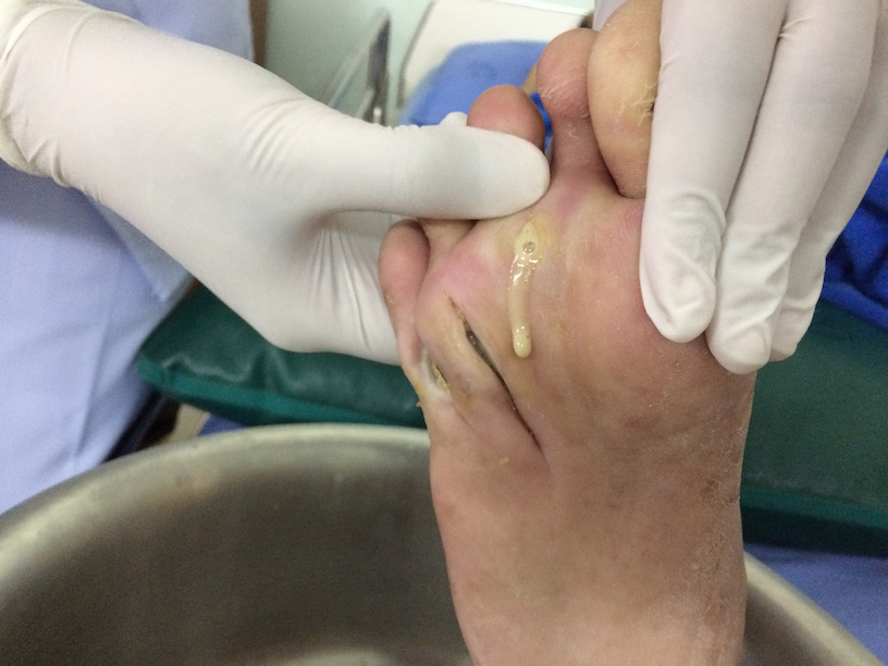 Có nên nặn mủ vết thương không là thắc mắc của nhiều người khi thấy vết thương xuất hiện mủ