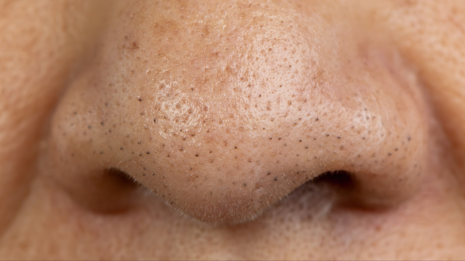 Có nên nặn mụn đầu đen không?