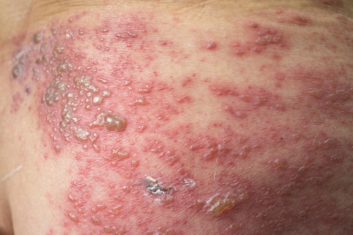 con-gioi-leo-la-gi-nhung-bien-chung-cua-benh-gioi-leo-ban-can-biet 3.png