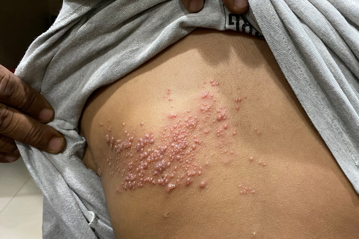 con-gioi-leo-la-gi-nhung-bien-chung-cua-benh-gioi-leo-ban-can-biet 5.png