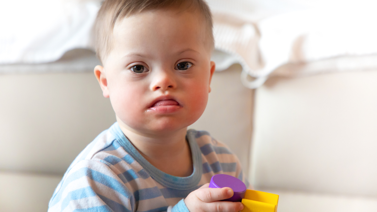 Hội chứng Down khi có thêm một bản sao của nhiễm sắc thể số 21