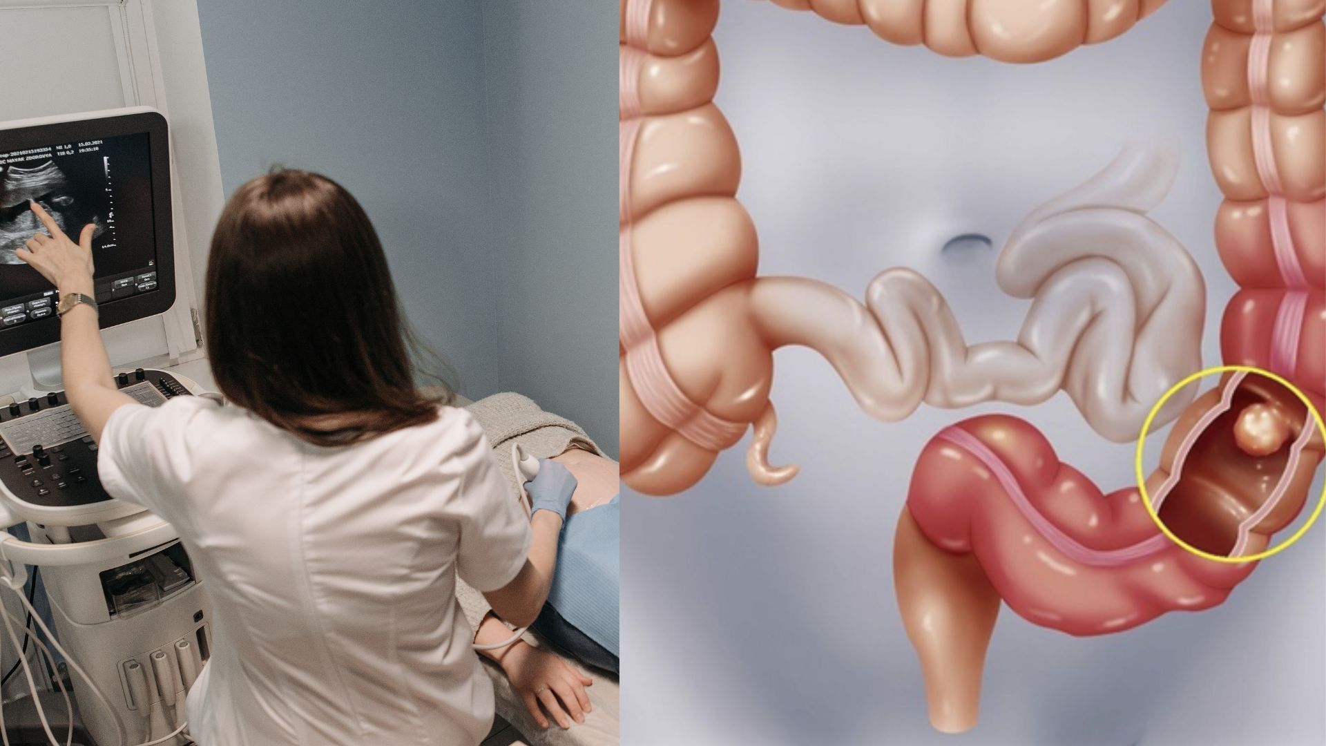 Cùng chuyên gia y tế giải đáp thắc mắc: Siêu âm có phát hiện ung thư đại tràng không? 1