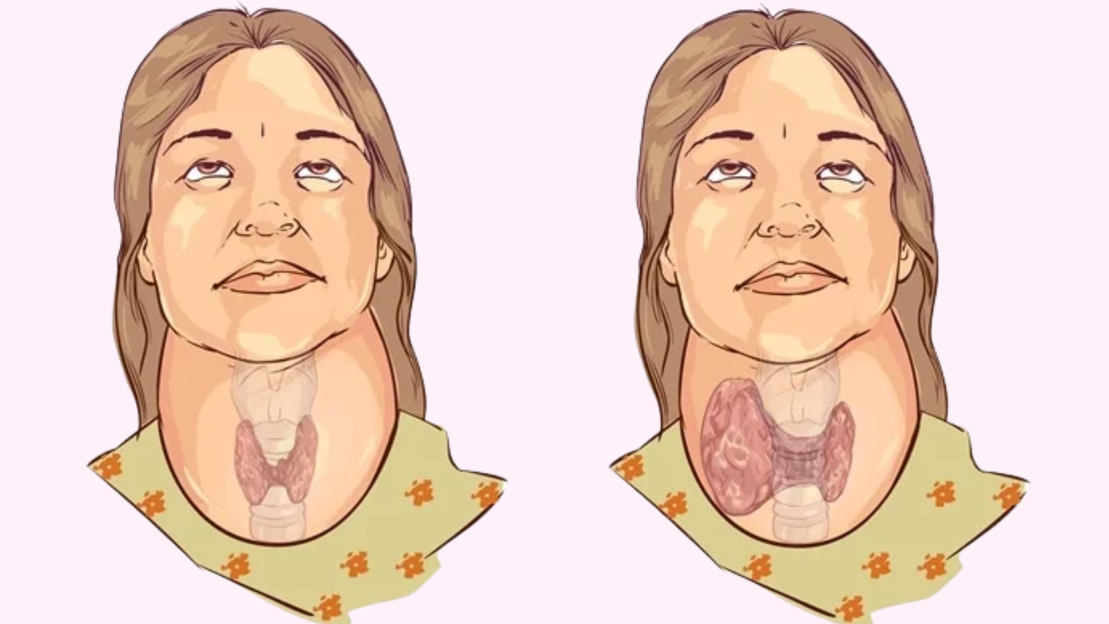 Bướu giáp đa nhân nhiễm độc gây tăng sinh mạch máu thường khu trú tại nhân