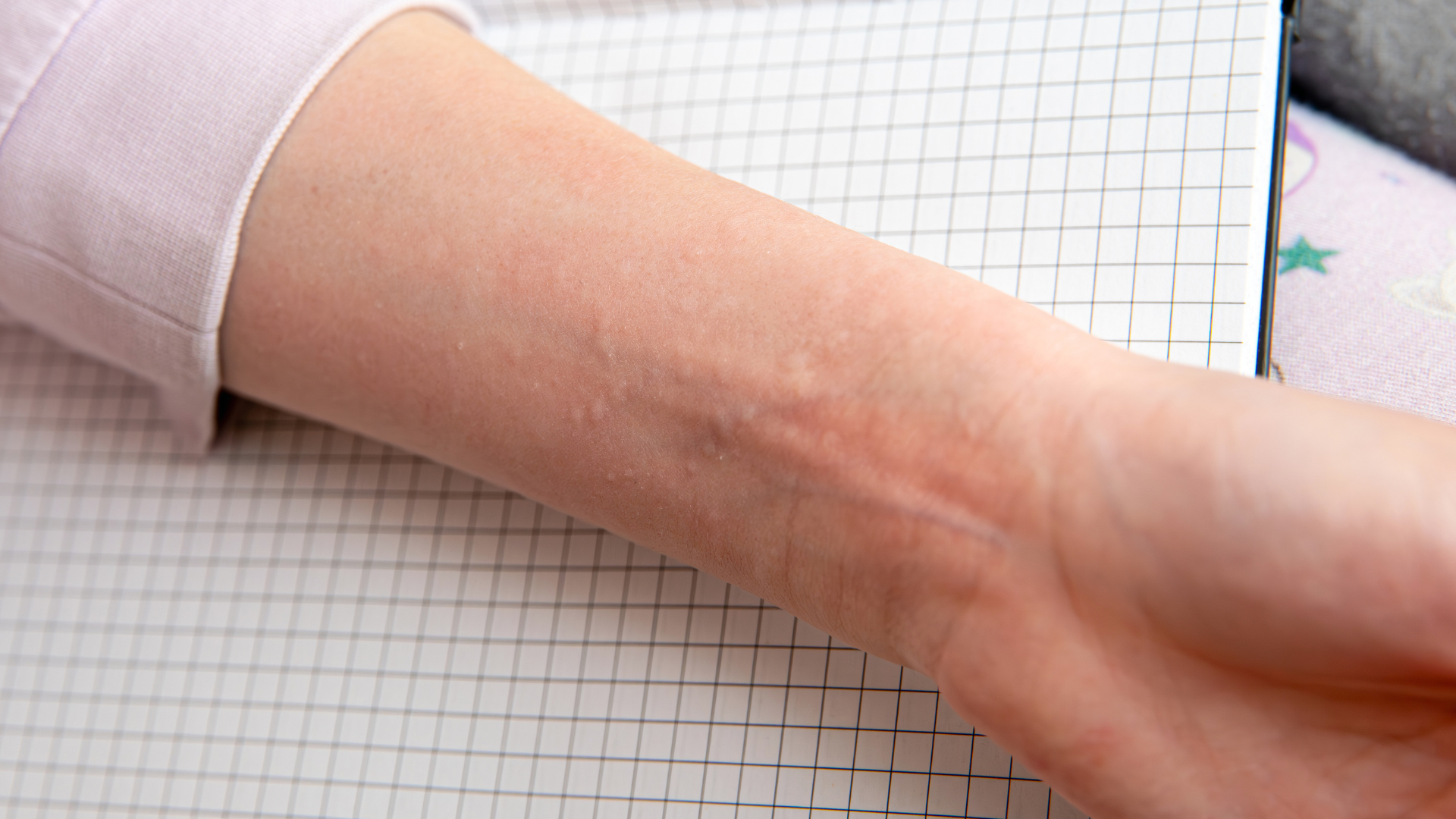 Nổi mề đay có thể khiến da bị ngứa gãi nổi hột​